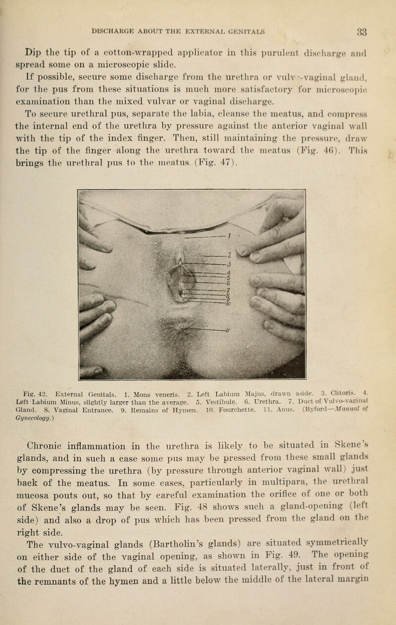 Dip the tip of a cotton-wrapped applicator in tliis j)iinilciit discliarge and spread some on a microscopic slide. If possible, secure some discharge from the urethra or vulv ^-vaginal gland, for the pus from these situations is much more satisfactory for micros('0])i(', examination than the mixed vulvar or vaginal discharge. To secure urethral pus, separate the lahia, cleanse the meatus, and compress the internal end of the urethra by pressure against the anterior vaginal wall with the tip of the index finger. Tlien, still maintaining the pressure, di-aw the tip of the finger along the urethra towai-d 1he meatus (Fig. 4(1). 'I'his brings the uretliral pus to tlie meatus (Fig. 47). Fig. 42. External Genitals. 1. Mons veneris. 2. Left Labium Majus, drawn aside. .3. Clitoris. 4. Left Labium Minus, slightly larger than the a,verage. 5. Vestibule. 6. Urethra. 7. Duct of Vulvo-Naginal Gland. 8. Vaginal Entrance. 9. Remains of Hymen. 10. Fourchette. 11. Anus. {ByfoT(\—Mnnual of Gynecology.) Chronic inflammation in the urethra is likely to be situated in Skene's glands, and in such a case some pus may be pressed from these small glands by compressing the urethra (by pressure through anterior vaginal wall) just back of the meatus. In some cases, particularly in multipara, the uretliral mucosa pouts out, so that by careful examination the orifice of one or both of Skene's glands may be seen. Fig. 48 shows such a gland-opening (left side) and also a drop of pus which has been pressed from the gland on the right side. The vulvo-vaginal glands (Bartholin's glands) are situated symmetrically on either side of the vaginal opening, as shown in Fig. 49. The opening of the duct of the gland of each side is situated laterally, just in front of the remnants of the hymen and a little below the middle of the lateral margin