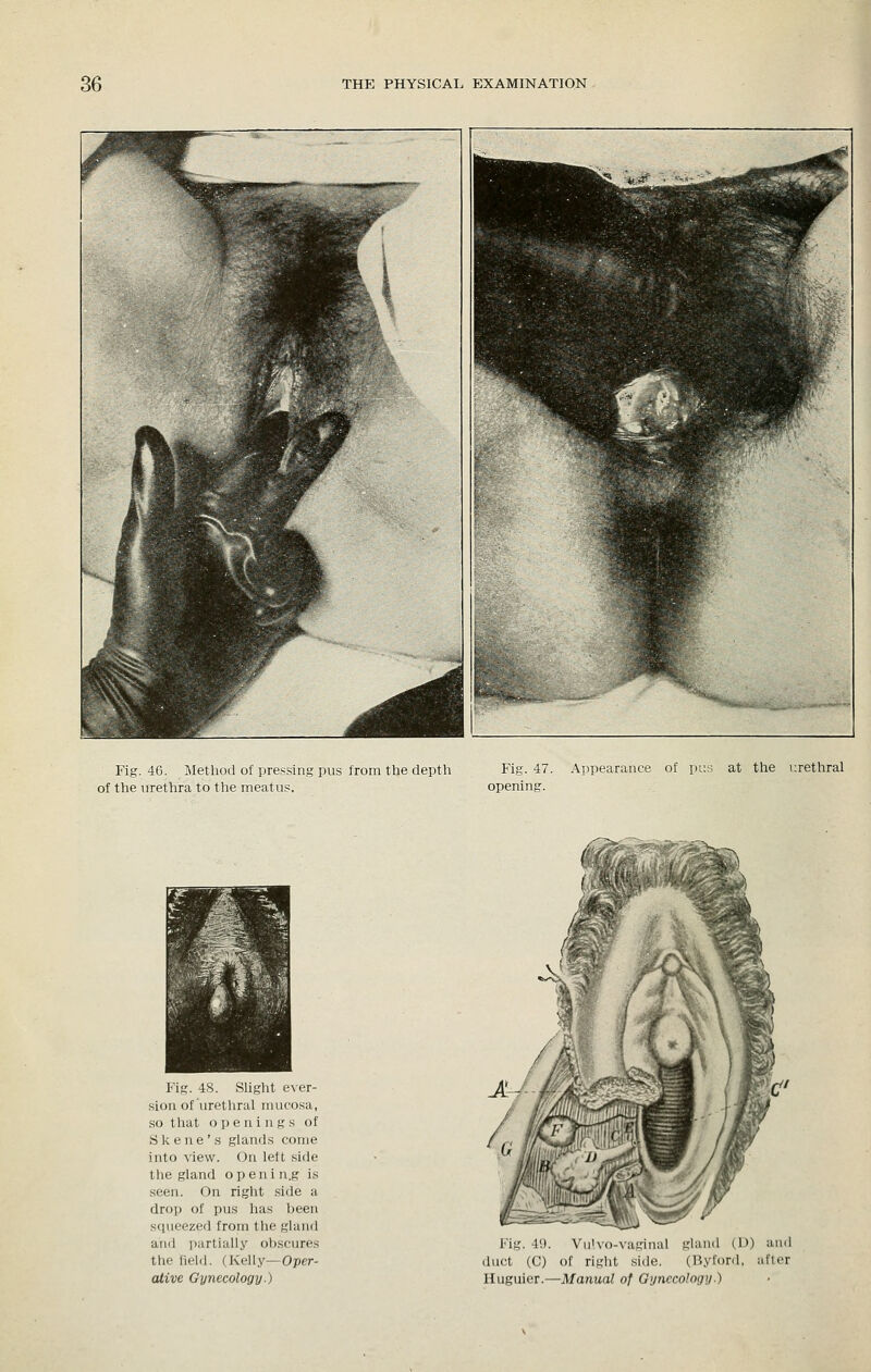 Fig. 46. Method of pressing pus from the depth Fig. 47. Appearance of pus at the i:rethral of the urethra to the meatus. opening. Fig. 48. Shght ever- sion of urethral mucosa, .so that openings of Skene's glands come into view. On left .side the gland openin.g is seen. On right .side a drop of pus lias been scjueezed from the gland and partially obscures the field. (Kelly—Oper- ative Gynecology.) Fig. 41). Viiivo-vaginal gland (D) duct (C) of right -side. (Byfonl, : Huguier.—Manual of Gynccolngij.) and ficr