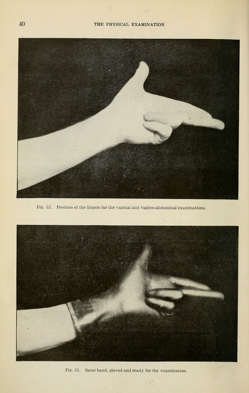 Fig. 52. Position of the fingers for the vaginal and vagino-abdominal examinations. Fig. 53. Same hand, gloved and ready for the examination.