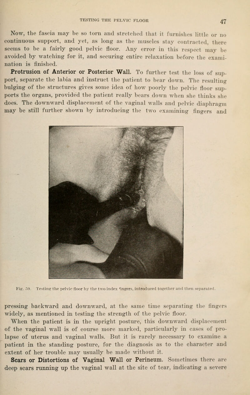 Now, the fascia may be so torn and stretched that it furnishes litth^ or no continuous support, and yet, as long as the muscles stay contracted, there seems to be a fairly good pelvic floor. Any error in Ihis respect may be avoided by watching for it, and securing entire rehixation before the exami- nation is finished. Protrusion of Anterior or Posterior Wall. To furtlier test the loss of sup- port, separate the labia and instruct the patient to ])ear down. Tlie resulting bulging of the structures gives some idea of how poorly the pelvic floor sup- ports the organs, provided the patient really bears down when she thinks she does. The downward displacement of the vaginal Avails and pelvic diaphragm may be still further shown by introducing tlie two examining fingers and Fig. .i9. Testing the pelvic floor by tlie two index *ingers, introduced togetlier and then separated. pressing backward and downward, at the same time separating the fingers widely, as mentioned in testing the strength of the pelvic floor. When the patient is in the upright posture, this downward displacement of the vaginal wall is of course more marked, particularly in cases of pro- lapse of uterus and vaginal walls. But it is rarely necessary to examine a patient in the standing posture, for the diagnosis as to the character and extent of her trouble may usually be made without it. Scars or Distortions of Vaginal Wall or Perineum. Sometimes there are deep scars running up the vaginal wall at the site of tear, indicating a severe