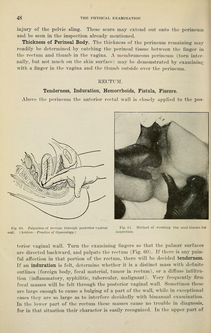 injury of the pelvic sling. These scars may extend out onto the perineum and be seen in the inspection already mentioned. Thickness of Perineal Body. The thickness of the perineum remaining may readily be determined by catching the perineal tissue between the finger in the rectum and thumb in the vagina. A membraneous perineum (torn inter- nally, but not much on the skin surface) may be demonstrated by examininp^' with a finger in the vagina and the thumb outside over the perineum. RECTITI\r. Tenderness, Induration, Hemorrhoids, Fistula, Fissure. Above the perineum the anterior rectal wall is closely applied to the pos- Fig. 60. Palpation of rectum through posterior vaginal wall. (Ashton—Practice of Gynecology.) Fig. 61. Method of everting inspection. the anal tissues for terior vaginal wall. Turn the examining fingers so that the palmar surfaces are directed backward, and palpate the rectum (Fig. 60). If there is any pain- ful affection in that portion of the rectum, there will be decided tenderness. If an induration is felt, determine whether it is a distinct mass with definite outlines (foreign body, fecal material, tumor in rectum), or a diffuse infiltra- tion (inflammatory, syphilitic, tubercular, malignant). Very frequently firm fecal masses will be felt through the posterior vaginal wall. Sometimes these are large enough to cause a bulging of a part of the wall, while in exceptional cases they are so large as to interfere decidedly with bimanual examination. In the lower part of the rectum these masses cause no trouble in diagnosis, for in that situation their character is easily recognized. In the upper, part of