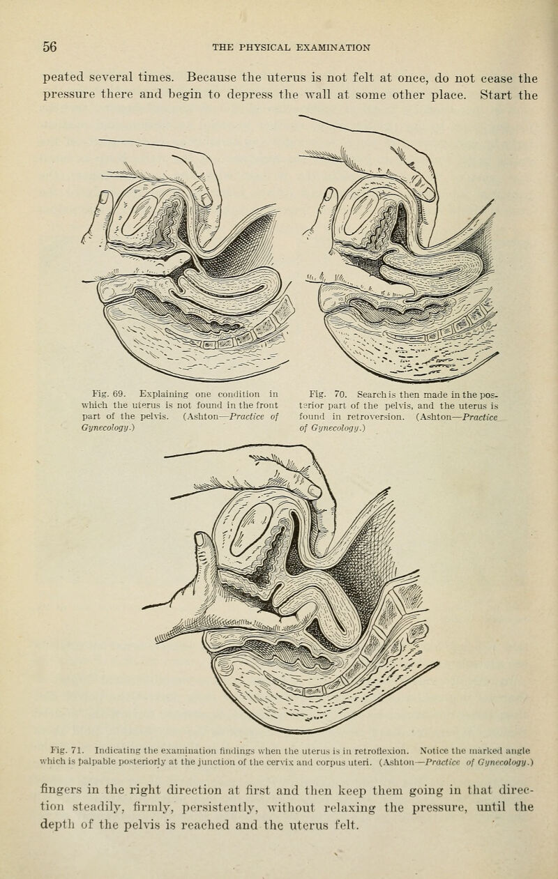 peated several times. Because the uterus is not felt at once, do not cease the pressure there and begin to depress the ^vall at some other place. Start the Fig. 69. Explaiiiing one condition in Fig. 70. Search is then made in the pos- which the uterus is not found in the front tsrior part of the pehis, and the uterus is part of the pehis. (Ashton—Practice of found in retroversion. (Ashton—Practice Gynecology.) ' of Gynecology.) Fig. 71. Indicating the examination findings when the uterus is in retroflexion. Notice the marked angle which is palpable posteriorly at the junction of the cervix and corpus uteri. (.Vshton—Practice of Gynecology.) fingers in the right direction at first and then keep them going in that direc- tion steadily, firiidy, persistently, -without relaxing the pressure, until the depth of the pelvis is reached and the uterus felt.