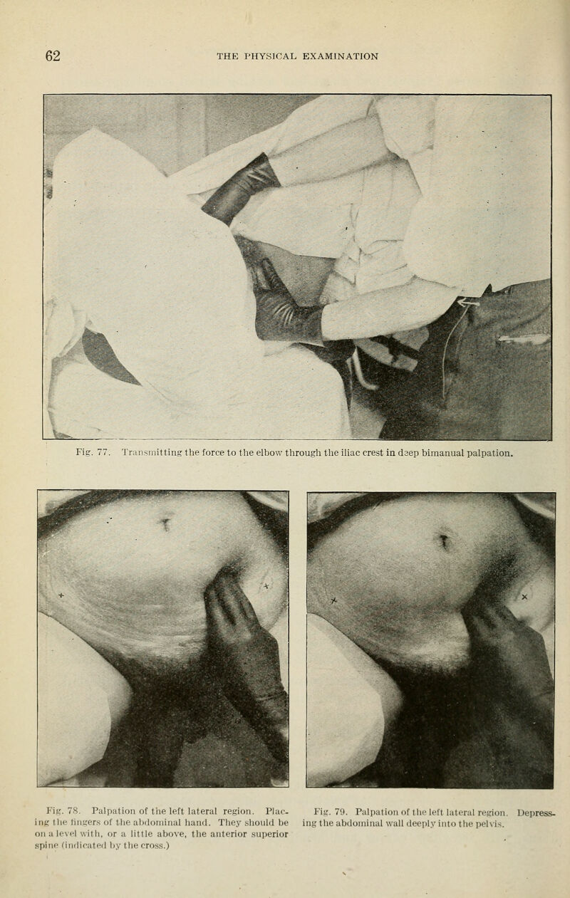 Fig. 77. Transmitting the force to the elbow through the iliac crest in dsep bimanual palpation. I'if,'. 7.S. Palpation of the left lateral rcKion. Plat-- ing tlie lingers of the abdominal hand. They sliould be on a level with, or a httle above, the anterior .superior spino fin(nfated by tlie cross.) I'ig. 79. Palpation of tlie left lateral region. ing the abdominal wall deeply into the pelvis. Depress-