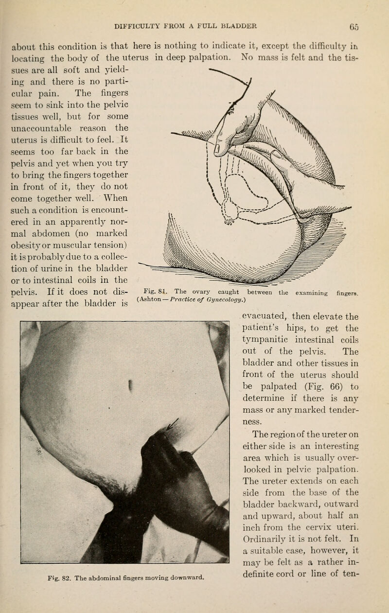 about this condition is that here is nothing to indicate it, except the difficulty in locating the body of the uterus in deep palpation. No mass is felt and the tis- sues are all soft and yield- ing and there is no parti- cular pain. The fingers seem to sink into the pelvic tissues well, but for some unaccountable reason the uterus is difficult to feel. It seems too far back in the pelvis and yet when you try to bring the fingers together in front of it, they do not come together well. When such a condition is encount- ered in an apparently nor- mal abdomen (no marked obesity or muscular tension) it is probably due to a collec- tion of urine in the bladder or to intestinal coils in the pelvis. If it does not dis- appear after the bladder is Fig. 81. The ovary caught between (Ashton — Practice of Gynecology.) the examining fingers. Fig. 82. The abdominal fingers moving downward. evacuated, then elevate the patient's hips, to get the tympanitic intestinal coils out of the pelvis. The bladder and other tissues in front of the uterus should be palpated (Fig. 66) to determine if there is any mass or any marked tender- ness. The region of the ureter on either side is an interesting area which is usualh' over- looked in pelvic palpation. The ureter extends on each side from the base of the bladder backward, outward and upward, about half an inch from the cervix uteri. Ordinarily it is not felt. In a suitable case, however, it may be felt as a rather in- definite cord or line of ten-