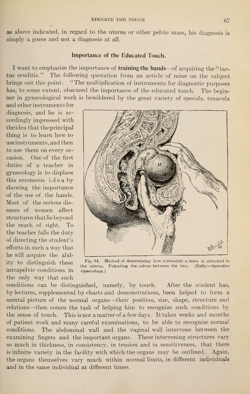 as above indicated, in regard to the uterus or other pelvic mass, his diagnosis is simply a guess and not a diagnosis at all. Importance of the Educated Touch. I want to emphasize the importance of training the hands—of acquiring thetac- tus eruditis. The following quotation from an article of mine on the subject brings out this point. The multiplication of instruments for diagnostic purposes has, to some extent, obscured the importance of the educated touch. The begin- ner in gynecological work is bewildered ])y the great variety of specula, tonacula and other instruments for diagnosis, and he is ac- cordingly impressed with the idea that the principal thing is to learn how to use instruments, and then to use them on every oc- casion. One of the first duties of a teacher in gynecology is to displace this erroneous idea by showing the importance of the use of the hands. Most of the serious dis- eases of women affect structures that lie beyond the reach of sight. To the teacher falls the duty of directing the student's efforts in such a way that he will acquire the abil- ity to distinguish these intrapelvic conditions in the only way that such conditions can be distinguished, namely, by touch. After the student has, by lectures, supplemented by charts and demonstrations, been helped to form a mental picture of the normal organs—their position, size, shape, structure and relations—then comes the task of helping him to recognize such conditions by the sense of touch. This is not a matter of a few days. It takes weeks and months of patient work and many careful examinations, to be able to recognize norma! conditions. The abdominal wall and the vaginal wall intervene between the examining fingers and the important organs. These intervening structures vary so much in thickness, in consistency, in tension and in sensitiveness, that there is infinite variety in the facility with which the organs may be outlined. Again, the organs themselves vary much within normal limits, in different individuals and in the same individual at different times. Fig. 84. Mechod of determining how intimately a mass is attached to the uterus. Palpating the sulcus between the two. (Kelly—Operative Gynecology.)