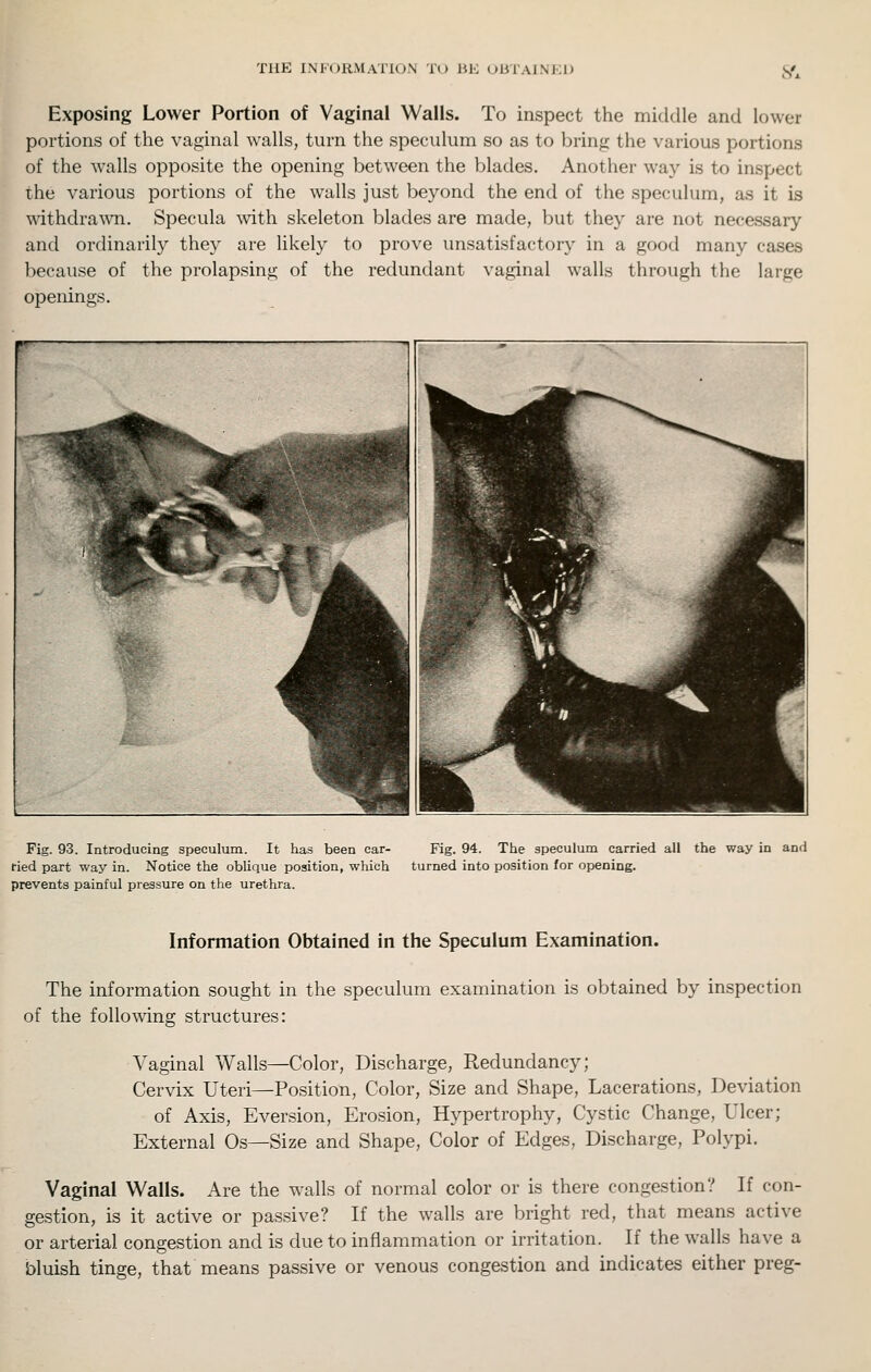 THE INFORMATION T(J BE OUTAINKI) S'x Exposing Lower Portion of Vaginal Walls. To inspect the middle and lower portions of the vaginal walls, turn the speculum so as to bring the various portions of the walls opposite the opening between the blades. Another way is to inspect ihe various portions of the walls just beyond the end of the speculum, as it is withdra^\^l. Specula with skeleton blades are made, but they are not necessary and ordinarily they are likely to prove unsatisfactory in a good many cases l^ecause of the prolapsing of the redundant vaginal walls through the large openings. Fig. 93. Introducing speculum. It has been car- ried part way in. Notice the oblique position, which prevents painful pressure on the urethra. Fig. 94. The speculum carried all the way in and turned into position for opening. Information Obtained in the Speculum Examination. The information sought in the speculum examination is obtained by inspection of the following structures: Vaginal Walls—Color, Discharge, Redundancy; Cervix Uteri^Position, Color, Size and Shape, Lacerations, Deviation of Axis, Eversion, Erosion, Hypertrophy, Cystic Change, Ulcer; External Os—Size and Shape, Color of Edges, Discharge, Polypi. Vaginal Walls. Are the walls of normal color or is there congestion? If con- gestion, is it active or passive? If the walls are bright red, that means active or arterial congestion and is due to inflammation or irritation. If the walls have a bluish tinge, that means passive or venous congestion and indicates either preg-