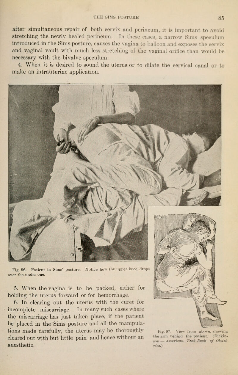 after simultaneous repair of both cervix arul perineum, it is important to avoid stretching the newly healed perineum. In these cases, a narrow Sims speculum introduced in the Sims posture, causes the vagina to balloon and exposes the cervix and vaginal vault with much less stretching of the vaginal orifice than would be necessary with the bivalve speculum. 4. When it is desired to sound the uterus or to dilate the cervical canal or to make an intrauterine application. Fig. 96. Patient in Sims' posture. Notice how the upper knee drops |^// over the under one. ■' 5. When the vagina is to be packed, either for holding the uterus forward or for hemorrhage. 6. In clearing out the uterus with the curet for incomplete miscarriage. In many such cases where the miscarriage has just taken place, if the patient be placed in the Sims posture and all the manipula- tions made carefully, the uterus may be thoroughly cleared out with but httle pain and hence without an anesthetic. Fig. 97. View the arm behind son — American fiCS.) e, showing (Dickin- nf Obttet-