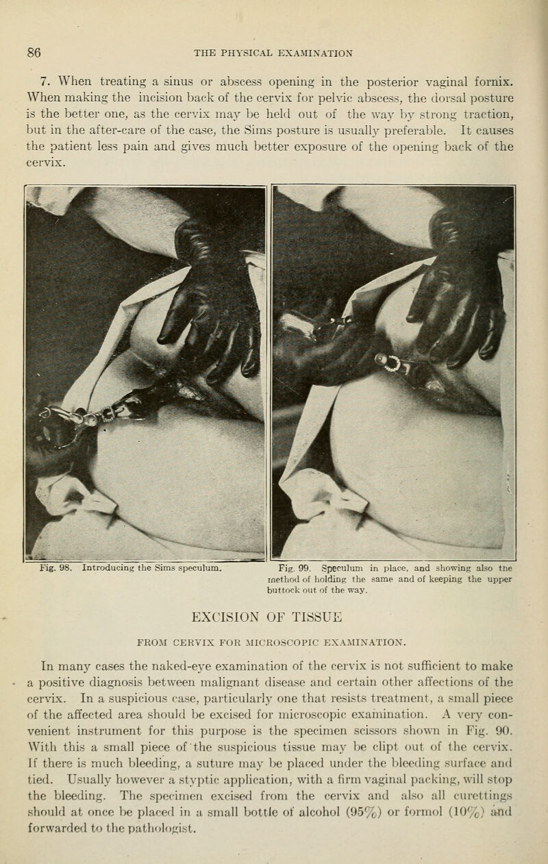 7. When treating a sinus or abscess opening in the posterior vaginal fornix. When making the incision back of the cervix for pelvic abscess, the dorsal posture is the better one, as the cervix may be held out of the way by strong traction, but in the after-care of the case, the Sims posture is usually preferable. It causes the patient less pain and gives much better exposure of the opening back of the cervix. Fig. 98. Introducing the Sims speculum. Fig. 99. Speculum in place, and showing also the method of holding the same and of keeping the upper buttock out of the way. EXCISION OF TISSUE FROM CERVIX FOR MICROSCOPIC EXAMINATION. In many cases the naked-eye examination of the cervix is not sufficient to make a positive diagnosis between malignant disease and certain other affections of the cervix. In a suspicious case, particularly one that resists treatment, a small piece of the affected area should be excised for microscopic examination. A very con- venient instrument for this purpose is the specimen scissors shown in Fig. 90. With this a small piece of the su.spicious tissue may be chpt out of the cervix. If there is much bleeding, a suture may be placed under the bleeding surface and tied. Usually however a styptic application, with a firm vaginal packing, will stop the bleeding. The specimen excised from the cervix and also all curettings should at once be placed in a small bottle of alcohol (95%) or formol (10%) imd forwarded to the pathologist.