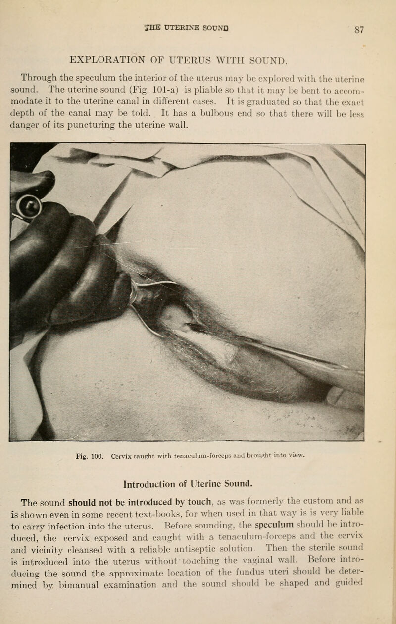 THE UTERINE SOUND EXPLORATION OF UTERUS WITH SOUND. Through the speculum the interior of the uterus may be explored with the uterine sound. The uterine sound (Fig. 101-a) is pliable so that it ma}^ be bent to accom- modate it to the uterine canal in different cases. It is graduated so that the exact depth of the canal may be told. It has a bulbous end so that there will ]m les.s danger of its puncturing the uterine wall. Fig. 100. Cervix caught with tenaculum-forceps and brought into view. Introduction of Uterine Sound. The sound should not be introduced by touch, as was formerly the custom and as is shown even in some recent text-lxx)ks, for when used in that way is is very liable to carry infection into the uterus. Before sounding, the speculum should be intro- duced, the cervix exposed and caught with a tenaculum-forceps and the cervix and vicinity cleansed with a reliable antiseptic solution. Then the sterile sound is introduced into the uterus without'Toaching the vaginal wall. Before intro- ducing the sound the approximate location of the fundus uteri should be deter- mined by bimanual examination and the sound should be shaped and guided