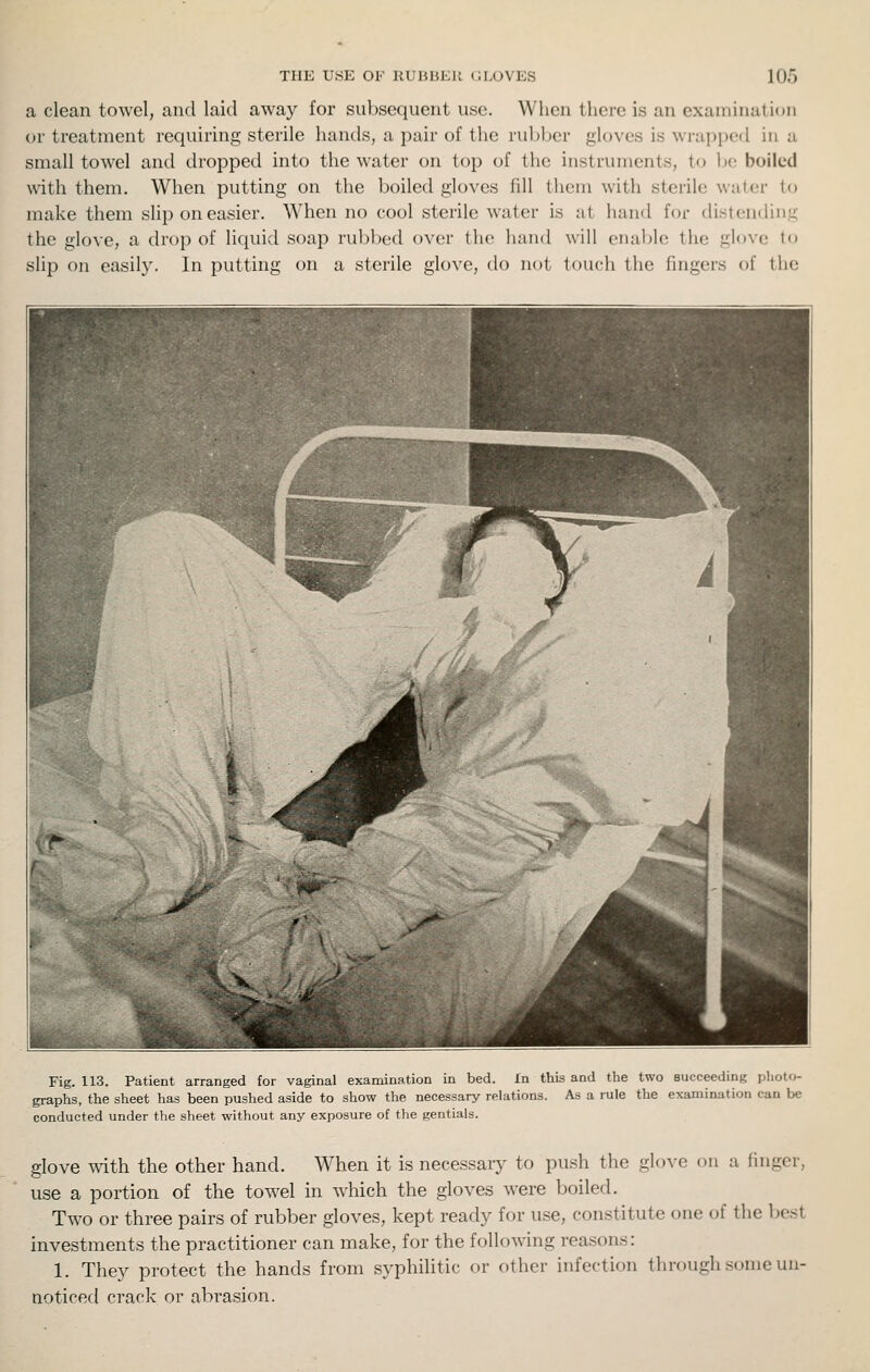 a clean towel, and laid away for subsequent use. When there is an examination or treatment requiring sterile hands, a pair of the rubber gloves is wrapped in a small towel and dropped into the water on top of the instruments, to be boiled with them. When putting on the boiled gloves fill them with sterile water to make them slip on easier. When no cool sterile water is at hand for distending the glove, a drop of liquid soap rubbed over the hand will enable the glove to slip on easily. In putting on a sterile glove, do not touch the fingers of the Fig. 113. Patient arranged for vaginal examination in bed. In this and the two succeeding photo- graphs, the sheet has been pushed aside to show the necessary relations. As a rule the examination can be conducted under the sheet without any exposure of the gentials. glove with the other hand. When it is necessary to push the glove on a finger, use a portion of the tow^el in which the gloves were boiled. Two or three pairs of rubber gloves, kept ready for use, constitute one of the best investments the practitioner can make, for the following reasons: 1. They protect the hands from syphilitic or other infection through some un- noticed crack or abrasion.