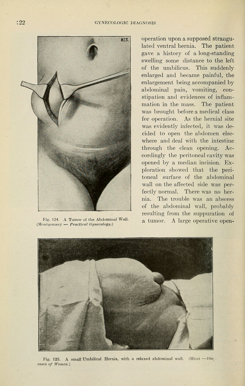 Fig. 124. (Montgomer A Tumor of the Abdominal Wall. y — Practical Gynecology.) operation upon a supposed strangu- lated ventral hernia. The patient gave a history of a long-standing sweHing some distance to the left of the umbilicus. This suddenly- enlarged and became painful, the enlargement being accompanied by abdominal pain, vomiting, con- stipation and evidences of inflam- mation in the mass. The patient was brought before a medical class for operation. As the hernial site was evidently infected, it was de- cided to open the abdomen else- where and deal with the intestine through the clean opening. Ac- cordingly the peritoneal cavity was opened by a median incision. Ex- ploration showed that the peri- toneal surface of the abdominal wall on the affected side was per- fectly normal. There was no her- nia. The trouble was an abscess of the abdominal wall, probably resulting from the suppuration of a tumor. A large operative open- Fig. 125. A small Umbilical Hernia, with a relaxed abdominal w:ill. (Ilirbt—Dis- eases of Women.)