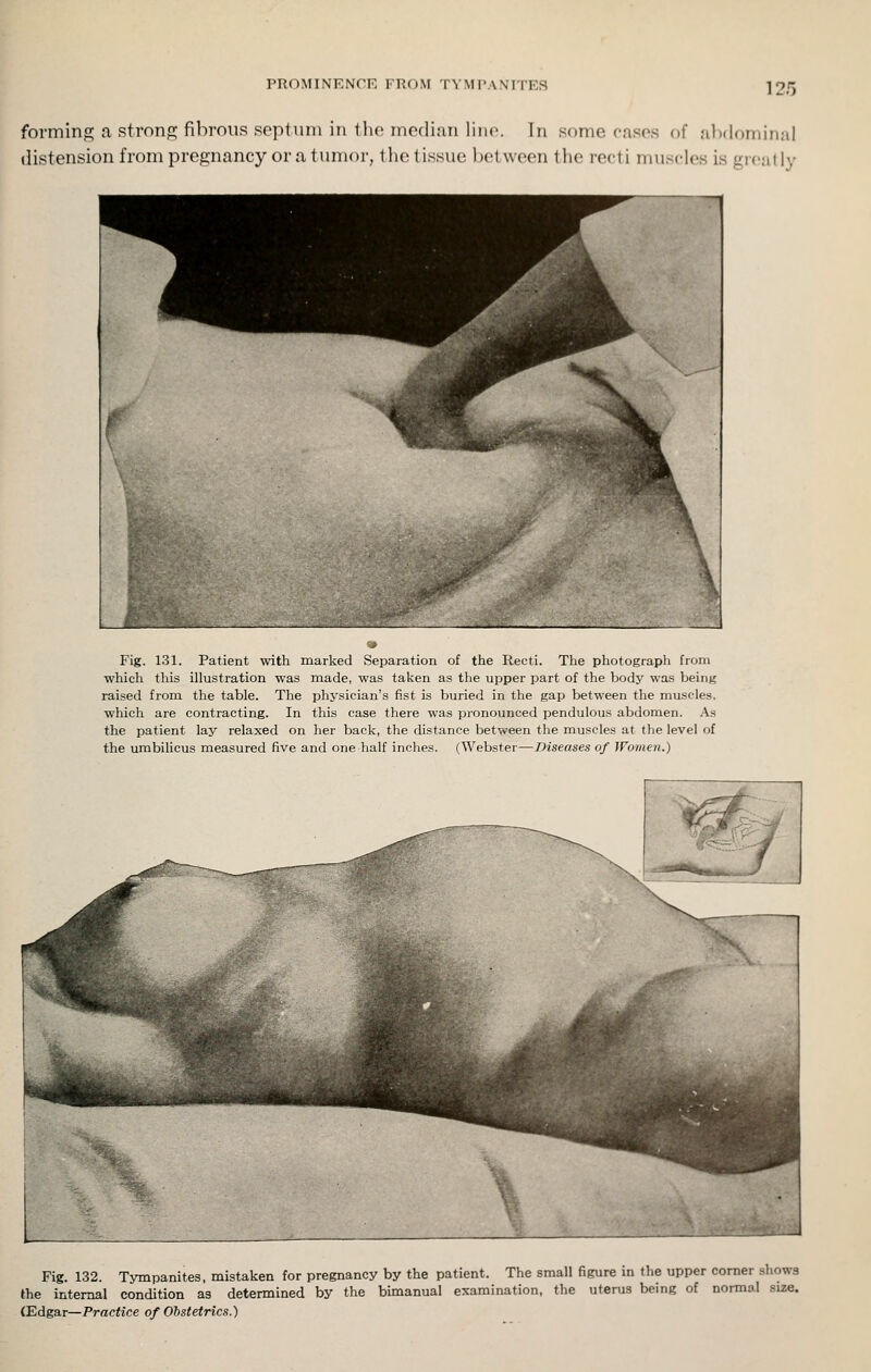 PROMINENCE FROM TYMPANITES forming a strong fibrous septum in the median line. In some cases of alidominal distension from pregnancy or a tumor, the tissue between the recti muscles is great ly Fig. 131. Patient with mariied Separation of the Recti. Tlie photograpli froiu which this illustration was made, was taken as the upper part of the body was being raised from the table. The physician's fist is buried in the gap between the muscles, which are contracting. In this case there was pionounced pendulous abdomen. As the patient lay relaxed on her back, the distance between the muscles at the level of the umbilicus measured five and one half inches. (Webster—Diseases of Women.) \ J Fig. 132. Tympanites, mistaken for pregnancy by the patient. The small figure in the upper corner shows the internal condition as determined by the bimanual examination, the uterus being of normal size. (Edgar—Practice of Obstetrics.)