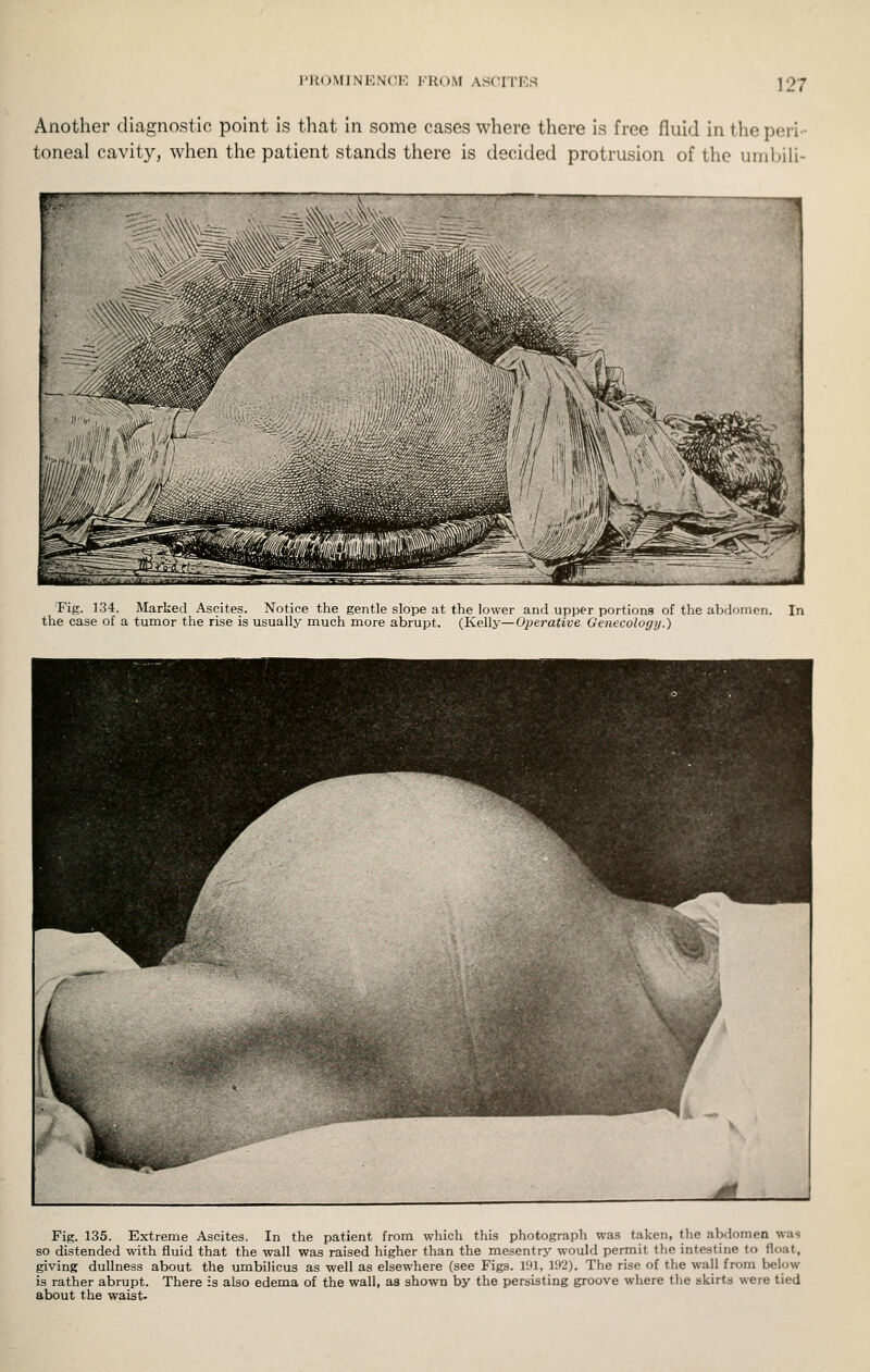 Another diagnostic point is that in some cases where there is free fluid in the peri- toneal cavity, when the patient stands there is decided protrusion of the uiiibiH- Fig. 134. Marked Ascites. Notice the gentle slope at the lower and upper portions of the abdomen. In the case of a tumor the rise is usually much more abrupt. (Kelly—Operative Gcnecology.) Fig. 135. Extreme Ascites. In the patient from which this photograph was taken, the abdomen was so distended with fluid that the wall was raised higher than the mesentry would permit the intestine to float, giving dullness about the umbilicus as well as elsewhere (see Figs. 191, 192). The rise of the wall from below is rather abrupt. There is also edema of the wall, as shown by the persisting groove where the skirts were tied about the waist.