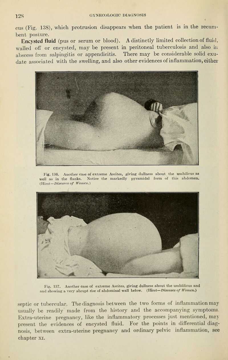 cus (Fig. 138), which protrusion disappears when the patient is in the recum- bent posture. Encysted fluid (pus or serum or blood). A distinctly Hmited collection of fluid, walled off or encysted, may be present in peritoneal tuberculosis and also in abscess from salpingitis or appendicitis. There may be considerable sohd exu- date associated with the swelling, and also other evidences of inflammation, either Fig. 136. Another case of extreme Ascites, giving dullness about the umbihcus aa well as in the flanks. Notice the markedly pyramidal form of this abdomen. {KiTst—Diseases of Women.) Fig. 137. Another case of extreme Ascites, giving dullness about the umblilicus and and showing a very abrupt rise of abdominal wall below. (Rivai—Diseases of ]Vomen.) septic or tubercular. The diagnosis between the two forms of inflammation may usually be readily' made from the history and the accompanying symptoms. Extra-uterine pregnancy, like the inflammatory processes just mentioned, may present the evidences of encysted fluid. P'or the points in differential diag- nosis, between extra-uterine pregnancy and ordinary pelvic inflammation, see chapter xi.