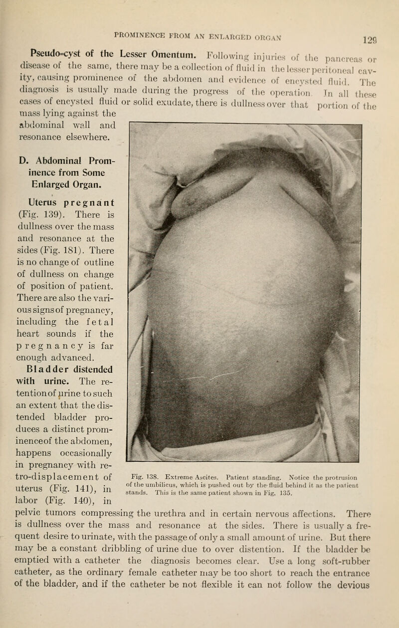 PROMINENCE FROM AN ENLARGED ORGAN 12Q Pseudo=cyst of the Lesser Omentum. Following injuries of tlie pancreas or disease of the same, there may be a collection of flui.l in the lesser peritoneal cav- ity, causing prominence of the abdomen and evidence of encysted fluid. The diagnosis is usually made during the progress of the operation, Jn all these cases of encysted fluid or solid exudate, there is dullness over that portion of the mass lying against the abtlominal wall and resonance elsewhere. D. Abdominal Prom- inence from Some Enlarged Organ. Uterus pregnant (Fig. 139). There is dullness over the mass and resonance at the sides (Fig. 181). There is no change of outUne of dullness on change of position of patient. There are also the vari- ous signs of pregnancy, including the fetal heart sounds if the pregnancy is far enough advanced. Bladder distended with urine. The re- tention of ,urine to such an extent that the dis- tended bladder pro- duces a distinct prom- inenceof the abdomen, happens occasionally in pregnancy with re- tro-displacement of uterus (Fig. 141), in labor (Fig. 140), in pelvic tumors compressing the urethra and in certain nervous affections. There is dullness over the mass and resonance at the sides. There is usually a fre- quent desire to urinate, with the passage of only a small amount of urine. But there may be a constant dribbling of urine due to over distention. If the bladder be emptied with a catheter the diagnosis becomes clear. Use a long soft-rubber catheter, as the ordinary female catheter may be too short to reach the entrance of the bladder, and if the catheter be not flexible it can not follow the devious Fig. 138. Extreme Ascites. Patient standing. Notice the protrusion of the umbilicus, which is pushed out by tlie-fluid behind it as the patient stands. This is the same patient shown in Fig. 135.