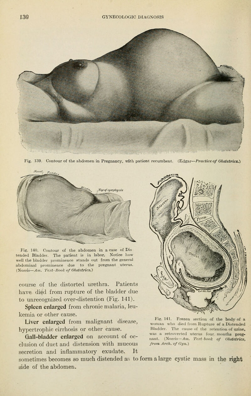 Fig. 139. Contour of the abdomen in Pregnancy, with patient recumbent. (Edgar—Practice of Obstetrics.) I Top o/si/mpht/sis / i ( ■■ I I, Fig. 140. Contour of the abdomen in a case of Dis- tended Bladder. The patient is in labor. Notice how well the bladder prominence stands out from the general abdominal prominence due to the pregnant uterus. (Norris—^m. Text-Bool: of Obstetrics.) course of the distorted urethra. Patients have died from rupture of the bladder due to unrecognized over-distention (Fig. 141). Spleen enlarged from chronic malaria, leu- kemia or other cause. Liver enlarged from malignant disease, hypertrophic cirrhosis or other cause. Gall=bladder enlarged on account of oc- clusion of duct and distension with mucous secretion and inflammatory exudate. It sometimes becomes so much distended a;) to form a large cystic mass in the right aide of the abdomen. Fig. 141. Frozen section of the body of a woman who died fiom Rupture of a Distended Bladder. The cau.se of (lie re'eiition of urine, was a retroverted uterus four months preg- nant. (Norri.s—.-Iw. Text-book of Obstetrics, from Arch, of Oyn.)