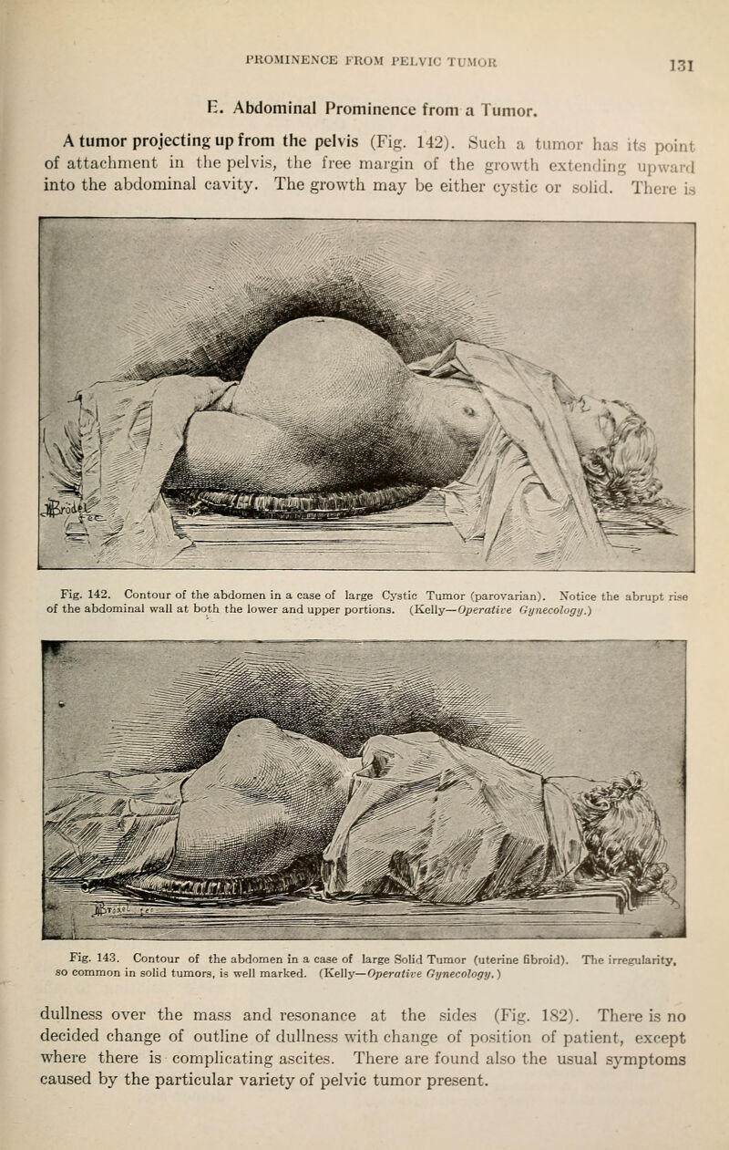 E. Abdominal Prominence from a Tumor. A tumor projecting up from the pelvis (Fig. 142). Such a tumor has its point of attachment in the pelvis, the free margin of the growth extending upward into the abdominal cavity. The growth may be either cystic or solid. There is Fig. 142. Contour of the abdomen in a case of large Cystic Tumor (parovarian). Notice the abrupt rise of the abdominal wall at both the lower and upper portions. (Kelly—Operative Gynecology.) Fig. 14.3. Contour of the abdomen in a case of large Solid Tumor (uterine fibroid). The irregularity, so common in solid tumors, is well marked. (Kelly—Operative Gynecology.) dullness over the mass and resonance at the sides (Fig. 1S2). There is no decided change of outline of dullness with change of position of patient, except where there is complicating ascites. There are found also the usual symptoms caused by the particular variety of pelvic tumor present.