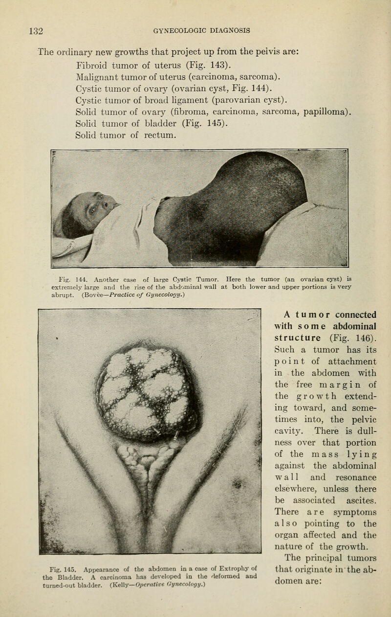 The ordinary new growths that project up from the pelvis are: Fibroid tumor of uterus (Fig. 143). MaUgnant tumor of uterus (carcinoma, sarcoma). Cj^stic tumor of ovary (ovarian cyst, Fig. 144). Cystic tumor of broad hgament (parovarian cyst). SoHd tumor of ovary (fibroma, carcinoma, sarcoma, papilloma). Solid tumor of bladder (Fig. 145). Solid tumor of rectum. Fig. 144. Another case of large Cystic Tumor. Here thie tumor (an ovarian cyst) is extremely large and the rise of the abdominal wall at both lower and upper portions is very abrupt. (Bovee—Practice of Gynecology.) Fig. 145. Appearance of the abdomen in a case of Extrophy of the Bladder. A carcinoma has developed in the <^leformed and turned-out bladder. {Ke\\y—Operative Gynecology.) A tumor connected with some abdominal structure (Fig. 146). Such a tumor has its point of attachment in the abdomen with the free margin of the growth extend- ing toward, and some- times into, the pelvic cavity. There is dull- ness over that portion of the mass lying against the abdominal wall and resonance elsewhere, unless there be associated ascites. There are symptoms also pointing to the organ affected and the nature of the growth. The principal tumors that originate in the ab- domen are: