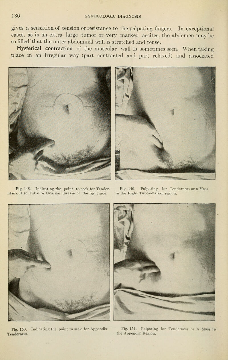 gives a sensation of tension or resistance to the palpating fingers. In exceptional cases, as in an extra large tumor or very marked ascites, the abdomen may be so filled that the outer abdominal wall is stretched and tense. Hysterical contraction of the muscular wall is sometimes seen. When taking place in an irregular way (part contracted and part relaxed) and associated Fig. 148. Indicating the point to seek for Tender- Fig. 149. Palpating for Tenderness or a Mass ness due to Tubal or Ovarian disease of tlie right side. in tlie Right Tubo-ovarian region. Fig. 150. Indicating the point to seek for Appendix Fig. 151. Palpating for Tenderness or a Mass in Tendemeea. the Appendix Region.