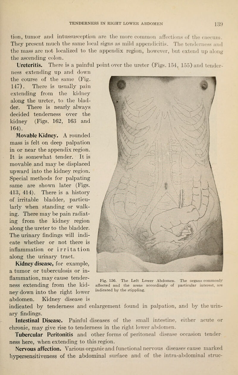 tion, tumor ami intussusccptiou mv the more cDiuiiion alYcctifHis of the caccuiii. Tliey present iiiucli the same local signs as mild a[)pen(liritis. The tenderness and the mass are not localized to the appendix region, however, hut extend up along the ascending colon. Ureteritis. There is a painful point over the ureter (Figs. 154, 155) and tender- ness extending up and down the course of the same (Fig. 147). There is usually pain extending from the kidney along the ureter, to the hlad- der. There is nearly always decided tenderness over the kidney (Figs. 162, 163 and 164). Movable Kidney. A rounded mass is felt on deep palpation in or near the appendix region. It is somewhat tender. It is movable and may be displaced upward into the kidney region. Special methods for palpating same are shown later (Figs. 413, 414). There is a history of irritable bladder, particu- larly when standing or w^alk- ing. There may be pain radiat- ing from the kidney region along the ureter to the bladder. The urinary findings will indi- cate whether or not there is inflammation or irritation along the urinary tract. Kidney disease, for example, a tumor or tuberculosis or in- flammation, may cause tender- „. ,„ _,, t f^ t auj tu i,. ' -^ Fig. 156. The Left Lower Abdomen. The organs commonly neSS extending from the kid- affected and the areas accordingly of particular interest, are ney down into the right lower '''^''■'^^ ^^ *^« ^*'pp'^^- abdomen. Kidney disease is indicated by tenderness and enlargement found in palpation, and by the urin- ary findings. Intestinal Disease. Painful diseases of the small intestine, either acute or chronic, may give rise to tenderness in the right lower abdomen. Tubercular Peritonitis and other forms of peritoneal disease occasion tender- ness here, when extending to this region. Nervous affection. Various organic and functional nervous diseases cause marked hj^ersensitiveness of the abdominal surface and of the intra-abdominal struc-