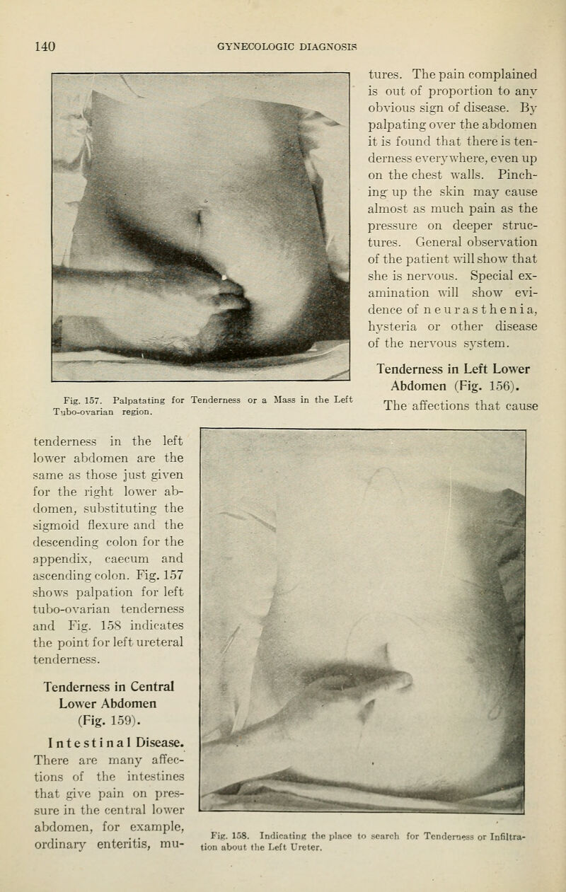 Fig. 157. Palpatating for Tenderness or a Mass in the Left T'jbo-ovarian region. tenderness in the left lower abdomen are the same as those just given for the right lower ab- domen, substituting the sigmoid flexure and the descending colon for the appendix, caecum and ascending colon. Fig. 157 shows palpation for left tubo-ovarian tenderness and Fig. 158 indicates the point for left ureteral tenderness. Tenderness in Central Lower Abdomen (Fig. 159). Intestinal Disease. There are many affec- tions of the intestines that give pain on pres- sure in the central lower abdomen, for example, ordinary enteritis, mu- tures. The pain complained is out of proportion to any obvious sign of disease. By palpating over the abdomen it is found that there is ten- derness ever}'where, even up on the chest walls. Pinch- ing up the skin may cause almost as much pain as the pressure on deeper struc- tures. General observation of the patient will show that she is nervous. Special ex- amination will show evi- dence of neurasthenia, hysteria or other disease of the nervous system. Tenderness in Left Lower Abdomen (Fig. 156). The affections that cause Fig. 158. IndicatinK the place to search for Tenderness or Infiltra- tion about tlie Left Ureter,