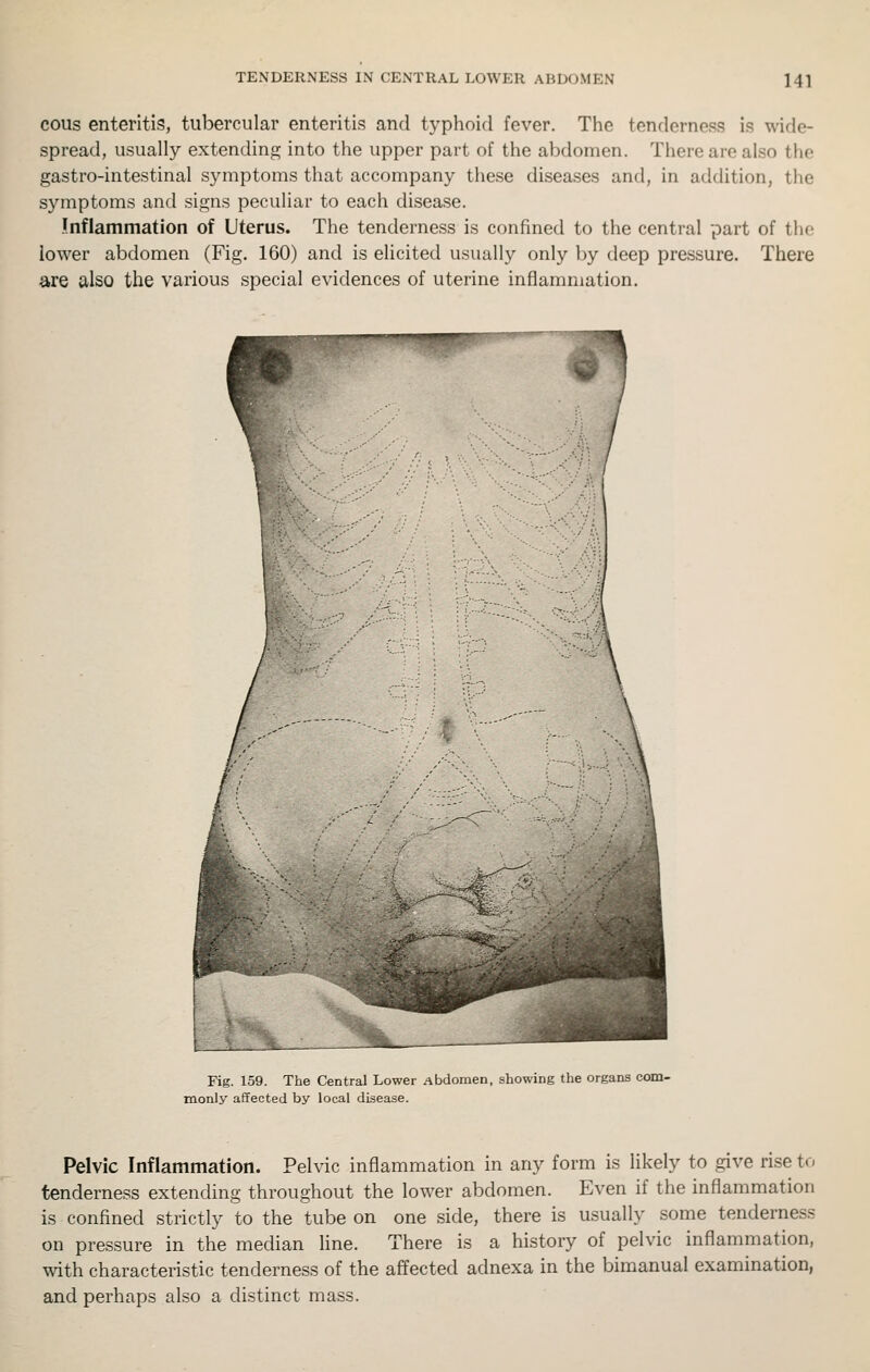 ecus enteritis, tubercular enteritis and typhoid fever. The tenderness is wide- spread, usually extending into the upper part of the abdomen. There are also the gastro-intestinal symptoms that accompany these diseases and, in addition, the symptoms and signs peculiar to each disease. Inflammation of Uterus. The tenderness is confined to the central part of the lower abdomen (Fig. 160) and is elicited usually only by deep pressure. There are also the various special evidences of uterine infiamniation. Fig. 159. The Central Lower Abdomen, showing the organs com- monly affected by local disease. Pelvic Inflammation. Pelvic inflammation in any form is likely to give rise to tenderness extending throughout the lower abdomen. Even if the inflammation is confined strictly to the tube on one side, there is usually some tenderness on pressure in the median line. There is a history of pelvic inflammation, with characteristic tenderness of the affected adnexa in the bimanual examination, and perhaps also a distinct mass.