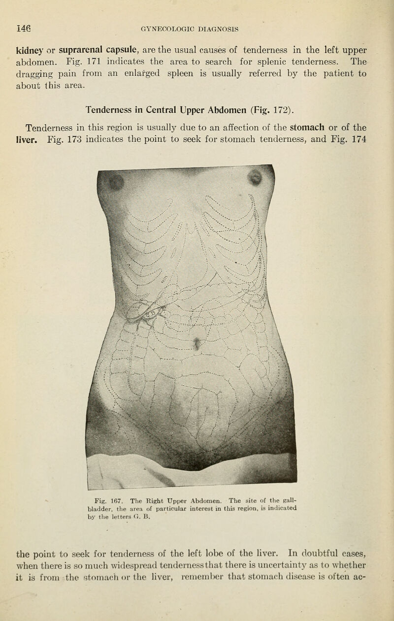 kidney or suprarenal capsule, are the usual causes of tenderness in the left upper abdomen. Fig. 171 indicates the area to search for splenic tenderness. The dragging pain from an enlarged spleen is usually referred by the patient to about this area. Tenderness in Central Upper Abdomen (Fig. 172). Tenderness in this region is usually due to an affection of the stomach or of the liver. Fig. 173 indicates the point to seek for stomach tenderness, and Fig. 174 i; i Fig. 167. The Right Upper Abdomen. The site of the gall- bladder, the area of particular interest in this region, is indicated by the letters G. B. the point to seek for tenderness of the left lobe of the liver. In doubtful cases, when there is so much widespread tenderness that there is uncertainty as to whether it is from the stomach or the liver, remember that stomach disease is often ac-