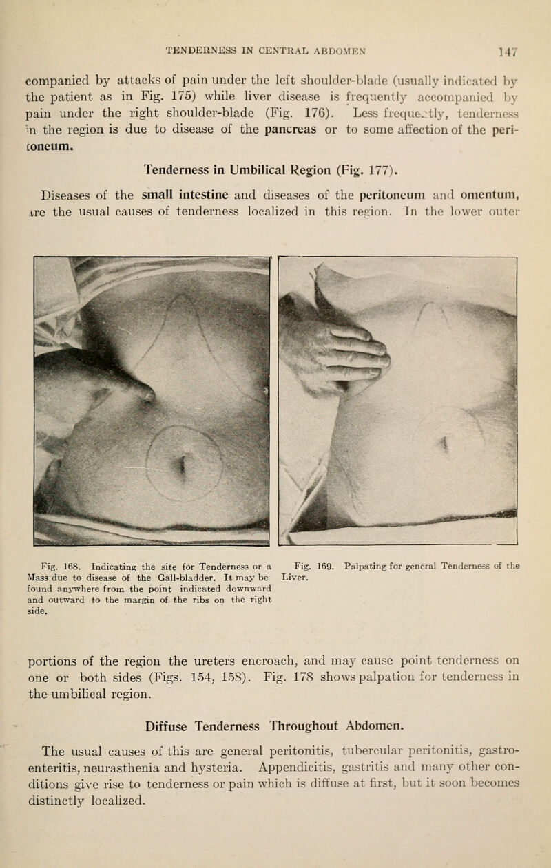 companied by attacks of pain under the left shoulder-blade (usually indicated by the patient as in Fig. 175) while liver disease is frequently accompanied l)y pain under the right shoulder-blade (Fig. 176). Less freque.:tly, tenderness ■n the region is due to disease of the pancreas or to some affection of the peri- toneum. Tenderness in Umbilical Region (Fig. 177). Diseases of the small intestine and diseases of the peritoneum and omentum, ire the usual causes of tenderness localized in this resion. In the lower outer Fig. 168. Indicating the site for Tenderness or a Mass due to disease of the Gall-bladder. It may be found anywhere from the point indicated downward and outward to the margin of the ribs on the right side. Fig. 169. Palpating for general Tenderness of the Liver. portions of the region the ureters encroach, and may cause point tenderness on one or both sides (Figs. 154, 158). Fig. 178 shows palpation for tenderness in the umbilical region. Diffuse Tenderness Throughout Abdomen. The usual causes of this are general peritonitis, tubercular peritonitis, gastro- enteritis, neurasthenia and hysteria. Appendicitis, gastritis and many other con- ditions give rise to tenderness or pain which is diffuse at first, but it soon becomes distinctly localized.