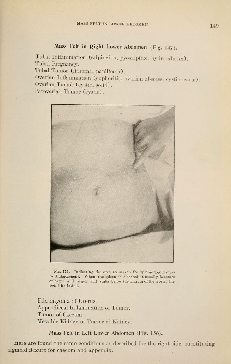 14!) Mass Felt in Right Lower Abdomen (Fig. J47). Tiil)al Inflanmiation (salpingitis, pyosalpiiix, ]iy<ln.salpiiix). Tubal Pregnancy. Tubal Tumor (fibroma, papilloma). Ovarian Inflammation (oophoritis, ovarian abscess, cystic ovary), Ovarian Tumor (cj-stic, solid). Parovarian Tumor (cystic). Fig. 171. Indicating the area to search for Splenic Tenderness or Enlargement. When the spleen is diseased it usually becomes enlarged and heavy and sinks below the margin of the ribs at the point indicated. Fibromyoma of Uterus. Appendiceal Inflammation or Tumor. Tumor of Caecum. Movable Kidney or Tumor of Kidney. iVlass Felt in Left Lower Abdomen (Fig. 156). Here are found the same conditions as described for the right side, substituting sigmoid flexure for caecum and appendix.