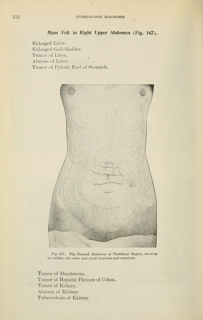 Mass Felt in Right Upper Abdomen (Fig. 167), Enlarged Liver. Enlarged Gall-bladder. Tumor of LiA^er. Abscess of Liver. Tumor of Pyloric End of Stomach. ~^ Fig. 177. The Central Abdomen or Umbilical Region, showing in outlipe the colon and small intestine and omentum. Tumor of Duodenum. Tumor of Hepatic Flexure of Colon. Tumor of Kidney. Abscess of Kidney. Tuberculosis of Kidney.