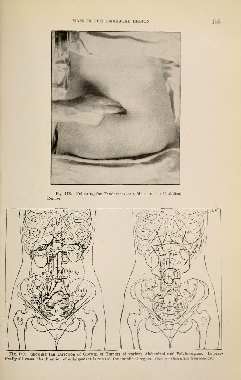 Fig 178. Palpating for Tenderness or a Mass in the Umbilical Region. l~P>^e^¥TZW7. Fig. 179. Showing the Direction of Growth of Tumors of various Abdominal and Pelvic organs. In prac- t:cally all cases, the direction of enlargement is toward the umbilical region. (KeWy—Operative Gynecology.)