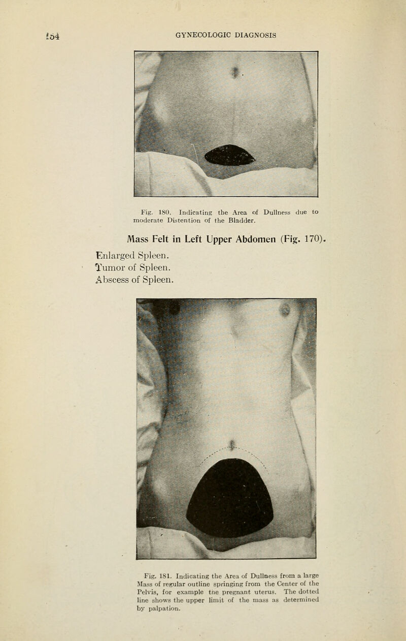 Fig. 180. Indicating the Area of Dullness due to moderate Distention of the Bladder. Mass Felt in Left Upper Abdomen (Fig. 170). Enlarged Spleen. Tumor of Spleen. Abscess of Spleen. Fig. 181. Indicating the .A.rea of Dullness from a large Mass of regular outline springing from the Center of the Pelvis, for example tne pregnant uterus. The dotted line shows the upper limit of the mass as determined by palpation.