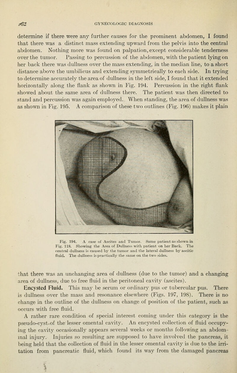 determine if there were any further causes for the prominent abdomen, I found that there was a distinct mass extending upward from the pelvis into the central abdomen. Nothing more was found on palpation, except considerable tenderness over the tumor. Passing to percussion of the abdomen, with the patient lying on her back there was dullness over the mass extending, in the median line, to a short distance above the umbilicus and extending symmetrically to each side. In trying to determine accurately the area of dullness in the left side, I found that it extended horizontally along the flank as shown in Fig. 194. Percussion in the right flank showed about the same area of dullness there. The patient was then directed to stand and percussion was again employed. When standing, the area of dullness was as shown in Fig. 195. A comparison of these two outlines (Fig. 196) makes it plain ■^ ,^Sm Iff SP-  ■^.. m 1 d ;: Hits :r %, t '^K d : f • .\.l '-\ ^ m - f • . - . r fi m : ::: ::: 11 :::: f ^ :: ;: ij. - l^i ^ ■ - - %'^W il^Hl :: 1? ■ I l^^ft W<r; ffi 1 T ■ m p ■ -^ m^ ^ ^^ = :; ^ n &V- . -^ ^mmmsmmSm 1 '^^ Fig. 194. A case of Ascites and Tumor. Same patient as shown in Fig. 118. Showing the Area of Dullness with patient on her Back. The central dullness is caused by the tumor and the lateral dullness by ascitic fluid. The dullness is practically the same on the two sides. that there was an unchanging area of dullness (due to the tumor) and a changing area of dullness, due to free fluid in the peritoneal cavity (ascites). Encysted Fluid. This may be serum or ordinary pus or tubercular pus. There is dullness over the mass and resonance elsewhere (Figs. 197, 198). There is no change in the outline of the dullness on change of position of the patient, such as occurs with free fluid. A rather rare condition of special interest coming under this category is the pseudo-cyst-of the'lesser omental cavity. An encysted collection of fluid occupy- ing the cavity occasionally appears several weeks or months following an abdom- inal injury. Injuries so resulting are supposed to have involved the pancreas, it being held that the collection of fluid in the lesser omental cavity is due to the irri- tation from pancreatic fluid, which found its way from the damaged pancreas