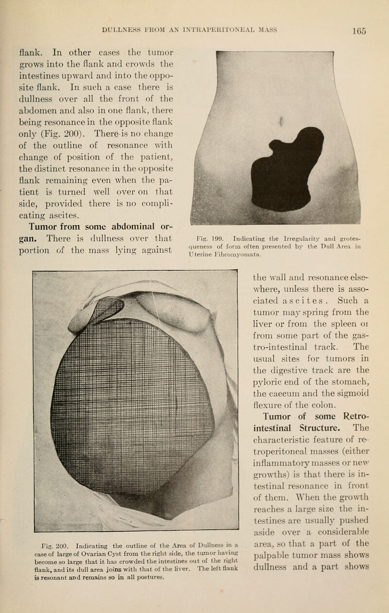 DULLNESS I'HOM AN INTUAI'EUITUNEAL MASS 1G5 flank. In other cases the tumor grows into the flank and crowds the intestines upward and into the oppo- site flank. In such a case there is dullness over all the front of the abdomen and also in one flank, there being resonance in the opposite flank only (Fig. 200). Tliere is no change of the outline of resonance with change of position of the patient, the distinct resonance in the opposite flank remaining even when the pa- tient is turned well over on that side, provided there is no compli- cating ascites. Tumor from some abdominal or= gan. There is dullness over that portion of the mass lying against Fig. 199. Indicating the Irregularity and grutes- queness of form often presented by the Dull .\rea in L'terine Fibromyomata. Fig. 200. Indicating the outline of the Area of Dullness in a case of large of Ovarian Cyst from the right side, the tumor ha\-ing become so large that it has crowded the intestines out of the right flank, and its dull area joins with that of the liver. The left flank is resonant and remains so in all postures. the wall and resonance else- where, unless there is asso- ciated ascites. Such a tumor may spring from the liver or from the spleen oi from some part of the gas- tro-intestinal track. The usual sites for tumors in the digestive track are the pyloric end of the stomach, the caecum and the sigmoid flexure of the colon. Tumor of some Retro- intestinal Structure. The characteristic feature of re- troperitoneal masses (either inflammatory masses or nev' growths) is that there is in- testinal resonance in front of them. When the growth reaches a large size the in- testines are usually pushed aside over a considerable area, so that a part of the palpable tumor mass shows dullness and a part shows