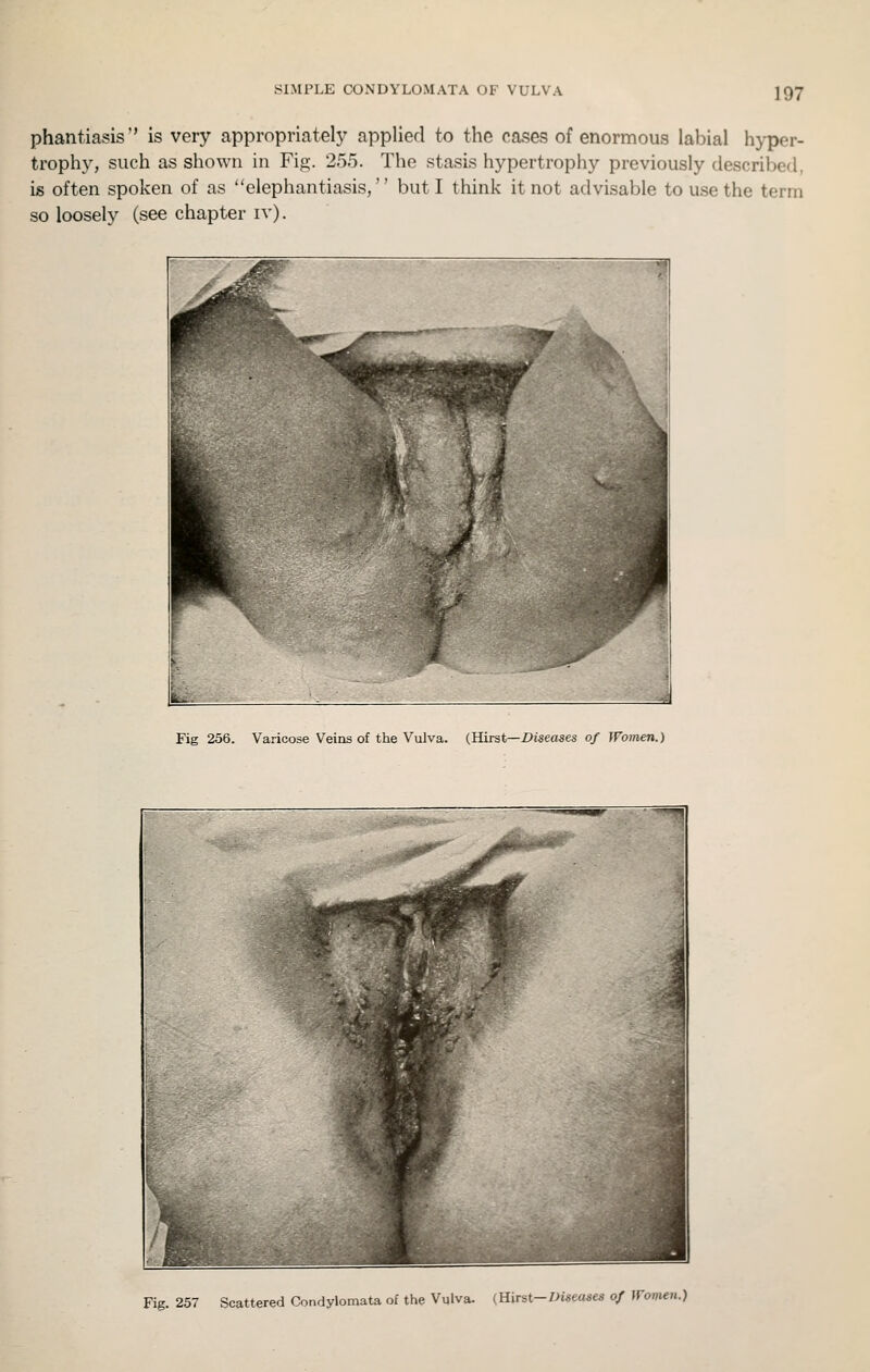 phantiasis'' is very appropriately applied to the cases of enormous labial hyper- trophy, such as shown in Fig. 255. The stasis hypertrophy previously described, is often spoken of as elephantiasis, but I think it not advisable to use the term so loosely (see chapter iv). Fig 256. Varicose Veins of the Vulva. (Hirst—Diseases of Women.) Fig. 257 Scattered Condylomata of the Vulva. (Hirst-Z>iseases of ffomen.)