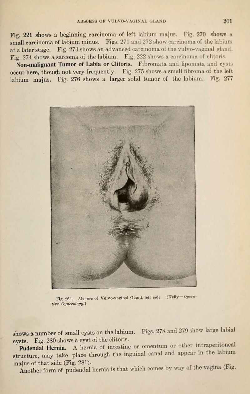 Fig. 221 shows a beginning carcinoma of left labium majus. Fig. 270 shows a small carcinoma of labium minus. Figs. 271 and 272 show carcinoma of the labium at a later stage. Fig. 273 shows an advanced carcinoma of the vulvo-vaginal gland. Fig. 274 shows a sarcoma of the labium. Fig. 222 shows a carcinoma of clitoris. Non-malignant Tumor of Labia or Clitoris. Fibromata and lipomata and cysts occur here, though not very frequently. Fig. 275 shows a small fibroma of the left labium majus. Fig. 276 shows a larger solid tumor of the labium. Fig. 277 Fig. 264. Abscess of Vulvo-vaginal Gland, left side. (Kelly—Opera- tive Gynecology.) shows a number of small cysts on the labium. Figs. 278 and 279 show large labial cysts. Fig. 280 shows a cyst of the clitoris. Pudendal Hernia. A hernia of intestine or omentum or other mtraperitoneai structure, may take place through the inguinal canal and appear in the labmm majusof that side (Fig. 281). • /x^- Another form of pudendal hernia is that which comes by way of the vagina (tig.