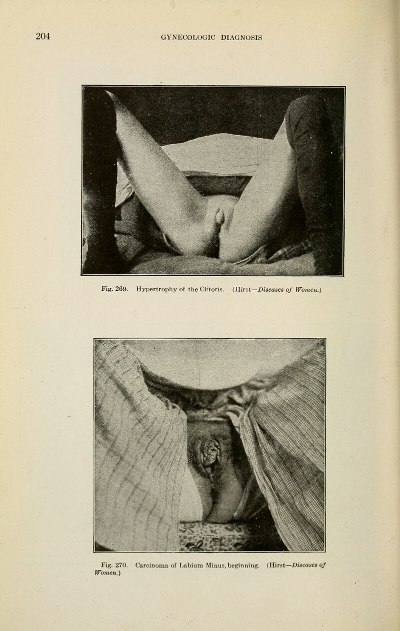 Fig. 269. Hypertrophy of the Clitoris. (Hirst—X>iseases of Wmnen.') Fig. 270. Carcinoma of Labium Minus, beginning. (Hirst—Z>iseases o/ Women.)