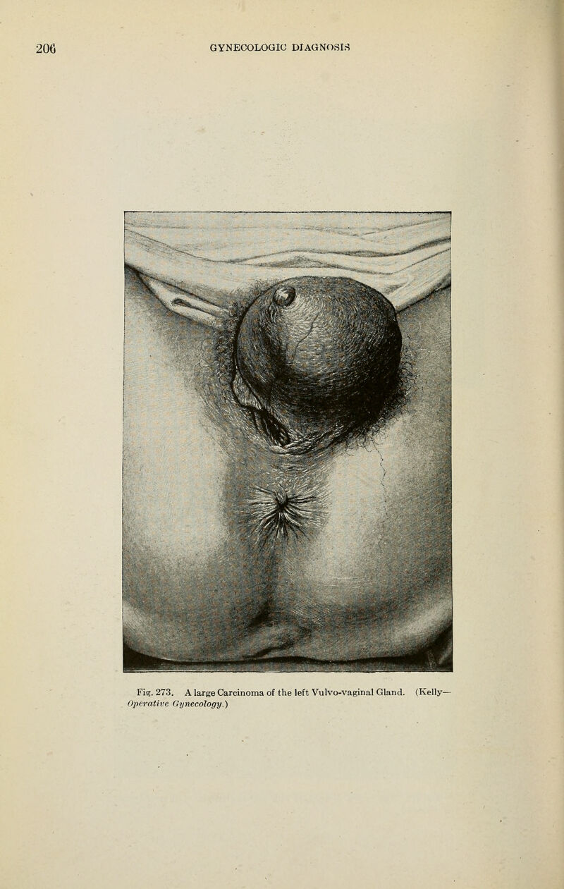 Fig. 273. A large Carcinoma of the left Vulvo-vaginal Gland. (Kelly- Operative Gynecology.)