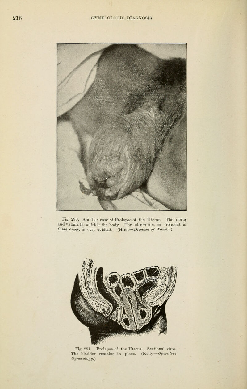 Fig. 290. Another case of Prolapse of the Uterus. The uterus and vagina lie outside the body. The ulceration, so frequent in these cases, is very e\'ident, (Hirst—Diseases of Women.) Fit;. 291. Prolapse of the Uterus. Sectional view The bladder remains in place. (Kelly—Operative Gynecology.)