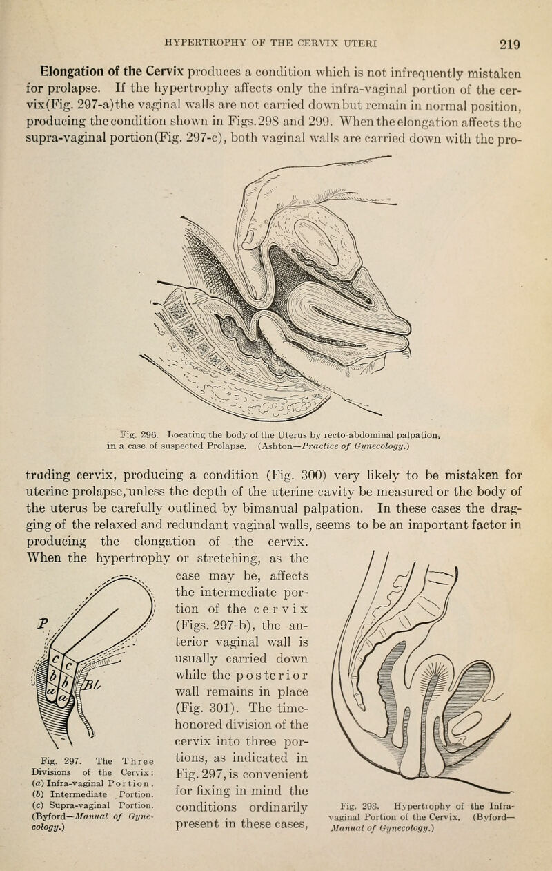 Elongation of the Cervix produces a condition which is not infrequently mistaken for prolapse. If the hypertrophy affects only the infra-vaginal portion of the cer- vix(Fig. 297-a)the vaginal walls are not carried downbut remain in normal position, producing the condition shown in Figs. 298 and 299. When the elongation affects the supra-vaginal portion(Fig. 297-c), both vaginal walls are carried down with the pro- Fig. 296. Locating the body of the Uterus by recto -abdominal palpation, in a case of suspected Prolapse. (Ashton—Practice of Gynecology.) trading cervix, producing a condition (Fig. 300) very likely to be mistaken for uterine prolapse, unless the depth of the uterine cavity be measured or the body of the uterus be carefully outlined by bimanual palpation. In these cases the drag- ging of the relaxed and redundant vaginal walls, seems to be an important factor in producing the elongation of the cervix. When the hypertrophy or stretching, as the case may be, affects the intermediate por- tion of the cervix (Figs. 297-b), the an- terior vaginal wall is usually carried down while the p o s te r i o r wall remains in place (Fig. 301). The time- honored division of the cervix into three por- tions, as indicated in Fig. 297, is convenient for fixing in mind the conditions ordinarily present in these cases, Fig. 297. The Three Divisions of the Cervix: (a) Infra-vaginal Portion. (6) Intermediate Portion, (c) Supra-vaginal Portion. (Byford—Manual of Gyne- cology.) Fig. 298. HjTDertrophy of the Infra- vaginal Portion of the Cerv'ix. (Byford—■ Manual of Gynecology.)