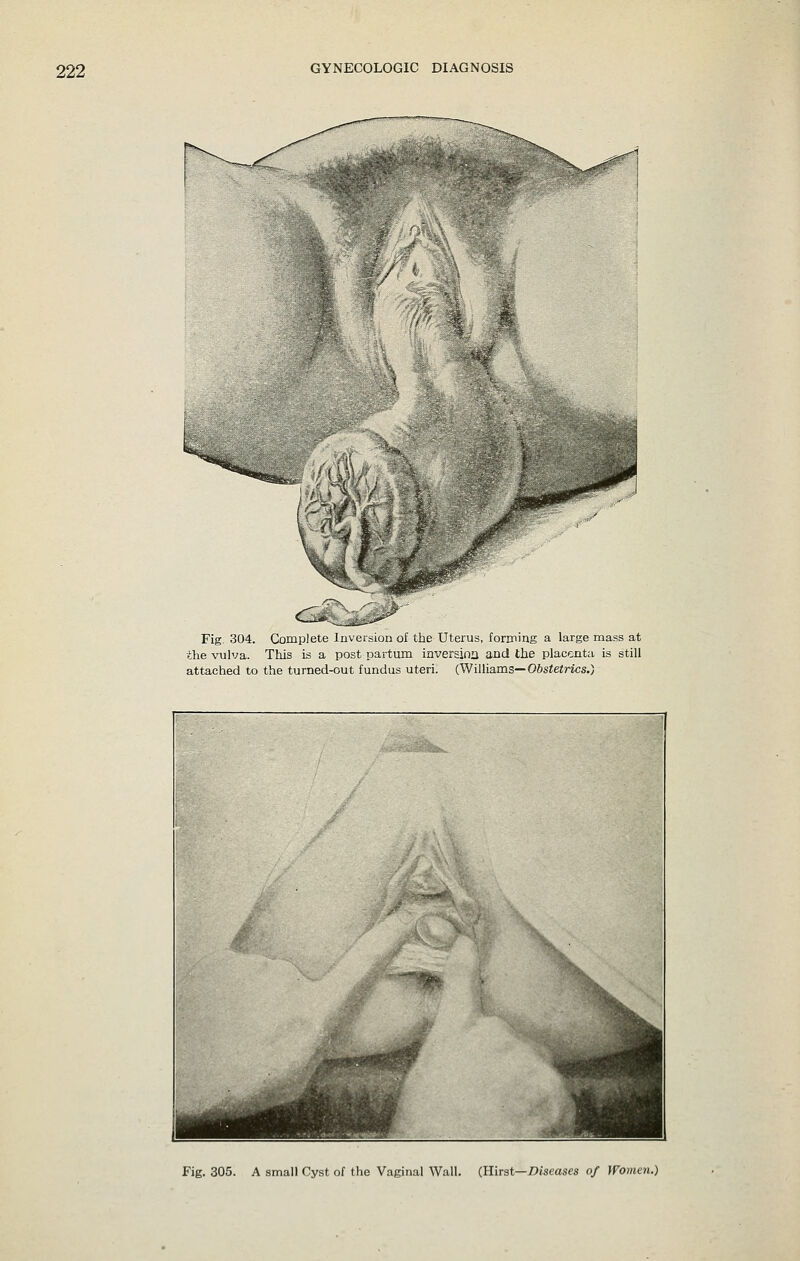 Fig. 304. Complete Jiivei&ionof the Uterus, forming a large mass at the vulva. This is a post partum inversina and the placenta is still attached to the turned-out fundus uteri. (Williams—Obstetrics.) Fig. 305. A small Cyst of the Vaginal Wall. (Uirat—Diseases of Women.)