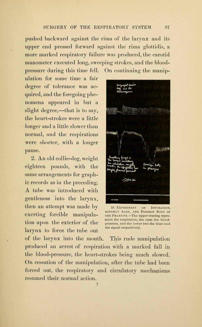 '■lif{l!'Mf!J^!^{r-.f.''''^! pushed backward against the rinia of the larynx and its upper end pressed forward against the rima glottidis, a more marked respiratory failure was produced, the carotid manometer executed long, sweeping strokes, and the blood- pressure during this time fell. On continuing the manip- ulation for some time a fair degree of tolerance was ac- quired, and the foregoing phe- nomena appeared in but a slight degree,—that is to say, the heart-strokes were a little longer and a little slower than normal, and the respirations were shorter, with a longer pause. 2. An old collie-dog, weight eighteen pounds, with the same arrangements for graph- ic records as in the preceding. A tube was introduced with gentleness into the larynx, then an attempt was made by exerting forcible manipula- tion upon the exterior of the larynx to force the tube out of the larynx into the mouth. This rude manipulation produced an arrest of respiration with a marked fall in the blood-pressure, the heart-strokes being much slowed. On cessation of the manipulation, after the tube had been forced out, the respiratory and circulatory mechanisms resumed their normal action. 7 19. Experiment on Intubation, roughly made, and foreign body in THE Pharynx.—The upper tracing repre- sents the respiration, the next the blood- pressure, and the lower two the time aud the signal respectively.