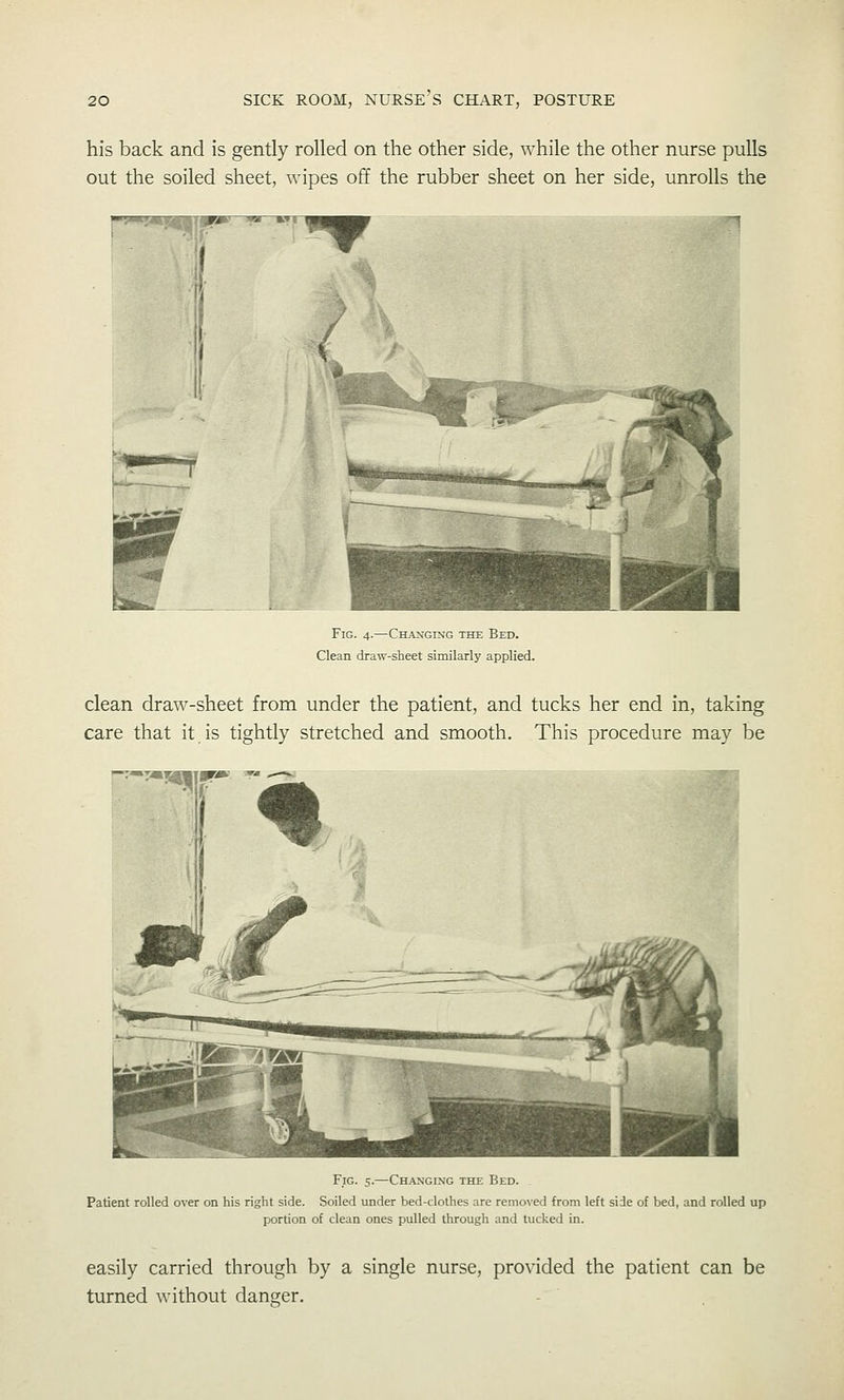 his back and is gently rolled on the other side, while the other nurse pulls out the soiled sheet, wipes off the rubber sheet on her side, unrolls the p^'ST'^ -JPS* ^—KfT Fig. 4.—Changing the Bed. Clean draw-sheet similarly applied. clean draw-sheet from under the patient, and tucks her end in, taking care that it.is tightly stretched and smooth. This procedure may be p-T«^' Fig. 5.—Changing the Bed. Patient rolled over on his right side. Soiled under bed-clothes are removed from left side of bed, and rolled up portion of clean ones pulled through and tucked in. easily carried through by a single nurse, provided the patient can be turned without danger.
