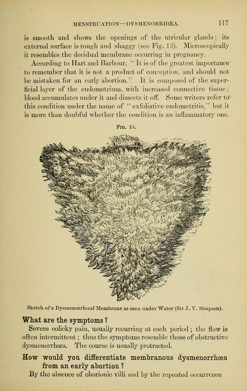 is smooth and shows the openings of the utricular glands; its external surface is rough and shaggy (see Fig. 13). Microscopically it resembles the decidual membrane occurring in pregnancy. According to Hart and Barbour, ' It is of the greatest importance to remember that it is not a product of conception, and should not be mistaken for an early abortion. It is composed of the super- ficial layer of the endometrium, with increased connective tissue; blood accumulates under it and dissects it off. Some writers refer to this condition under the name of  exfoliative endometritis, but it is more than doubful whether the condition is an inflammatory one. Sketcli of a Dysmenorrhceal Membrane as seen under Water (Sir J. Y. Simpson). What are the symptoms ? Severe colicky pain, usually recurring at each period ; the flow is often intermittent; thus the symptoms resemble those of obstructive dysmenorrhoea. The course is usually protracted. How would you differentiate membranous dysmenorrhcea from an early abortion ? By the absence of chorionic villi and by the repeated occurrence