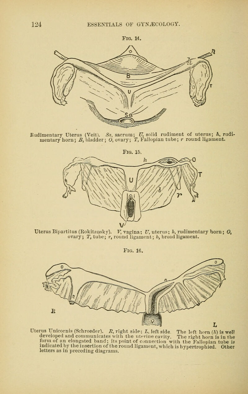 Fig. 14. Budimentary Uterus (Veit). Sa, sacrum; U, solid rudiment of uterus; h, rudi- mentary horn; B, bladder; 0, ovary; T, Fallopian tube; r round ligament. Fig. 15. Uterus Bipartitus (Rokitansky). FJ vagina; C7; uterus; 7i, rudimentary horn; 0, ovary; T, tube; r, round ligament; b, broad ligament. Fig. 16. Uterus TJnicornis (Schroeder). R, right side; L, left side. The left horn (h) is well developed and communicates -with the uterine cavity. The right horn is in the form of an elongated band; its point of connection with the Fallopian tube is indicated by the insertion of the round ligament, which is hypertrophied. Othej letters as in preceding diagrams.