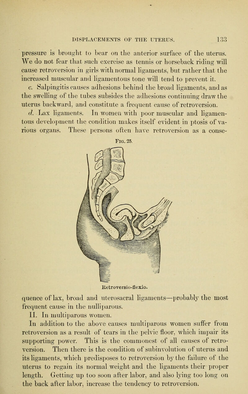 pressure is brought to bear on the anterior surface of the uterus. We do not fear that such exercise as tennis or horseback riding will cause retroversion in girls with normal ligaments, but rather that the increased muscular and ligamentous tone will tend to prevent it. c. Salpingitis causes adhesions behind the broad ligaments, and as the swelling of the tubes subsides the adhesions continuing draw the uterus backward, and constitute a frequent cause of retroversion. <7. Lax ligaments. In women with poor muscular and hgamen- tous development the condition makes itself evident in ptosis of va- rious organs. These persons often have retroversion as a conse- FlG. 25. Retro versio-fiexio. quence of lax, broad and uterosacral ligaments—probably the most frequent cause in the nuUi parous. II. In multiparous women. In addition to the above causes multiparous women suffer from retroversion as a result of tears in the pelvic floor, which impair its supporting power. This is the commonest of all causes of retro- version. Then there is the condition of subinvolution of uterus and its ligaments, which predisposes to retroversion bj the failure of the uterus to regain its normal weight and the ligaments their proper length. Getting up too soon after labor, and also lying too long on the back after labor, increase the tendency to retroversion.