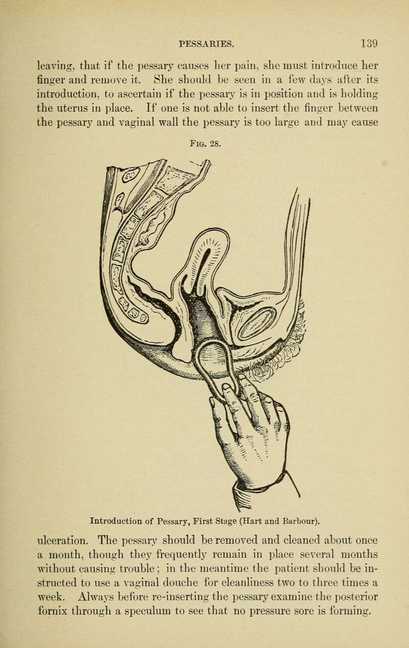 leaving, that if the pessary causes her pain, she must introduce her finger and remove it. She should be seen in a few days after its introduction, to ascertain if the pessary is in position and is holding the uterus in place. If one is not able to insert the finger between the pessary and vaginal wall the pessary is too large and may cause Fig. 28. Introduction of Pessary, First Stage (Hart and Barbour). ulceration. The pessary should be removed and cleaned about once a month, though they frequently remain in place several months without causing trouble; in the meantime the patient should be in- structed to use a vaginal douche for cleanliness two to three times a week. Always before re-inserting the pessary examine the posterior fornix through a speculum to see that no pressure sore is forming.