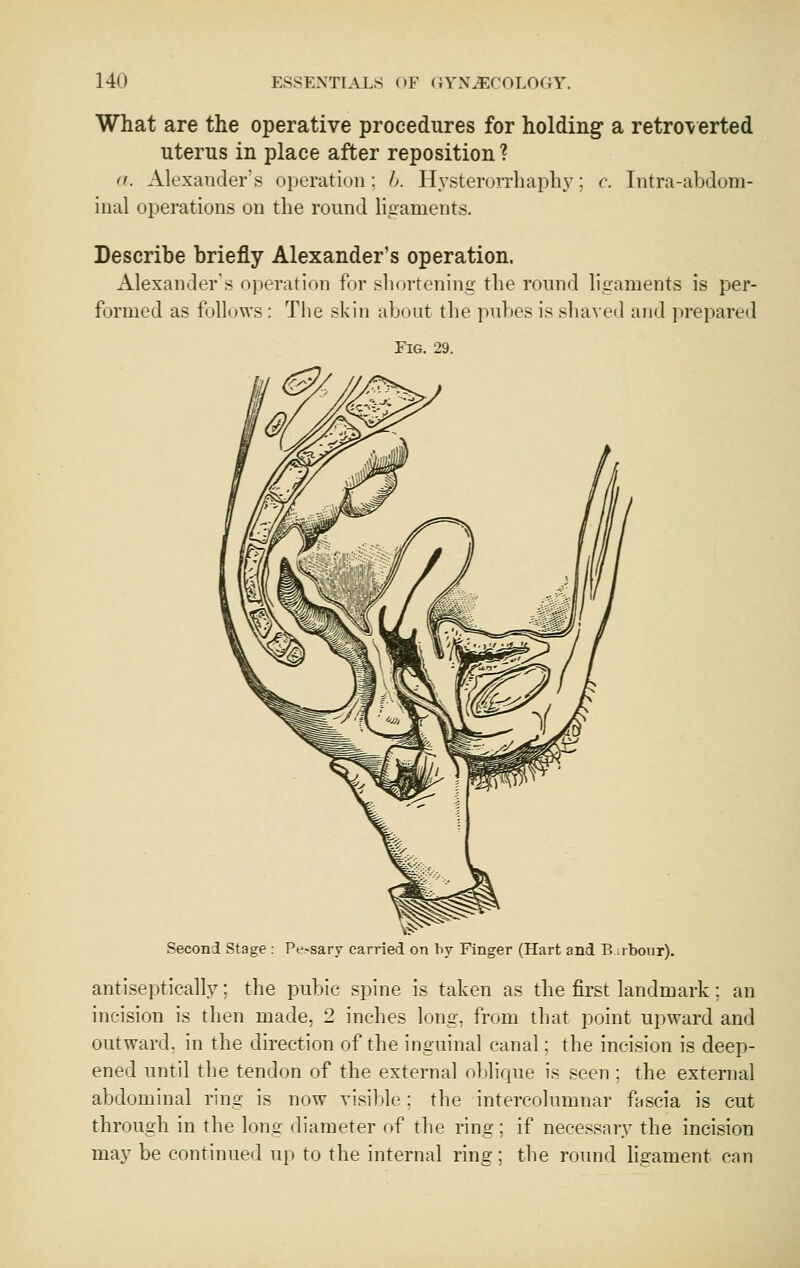 What are the operative procedures for holding a retro\erted uterus in place after reposition ? a. Alexander's operation: h. Hysterorrhaplij^; c. Intra-abdom- inal operations on the round hgaments. Describe briefly Alexander's operation. Alexander's operation for shortening the round ligaments is per- formed as follows : The skin about the pubes is shaved and prepared Fig. 29. Seconl Stage : Pe-sary carried on by Finger (Hart and P> .rboiir). antiseptically; the pubic spine is taken as the first landmark; an incision is then made, 2 inches long, from that point upward and outward, in the direction of the inguinal canal; the incision is deep- ened until the tendon of the external oblique is seen : the external abdominal ring is now visible; the intercolumnar fascia is cut through in the long diameter of the ring; if necessary the incision may be continued up to the internal ring; the ronnd ligament can