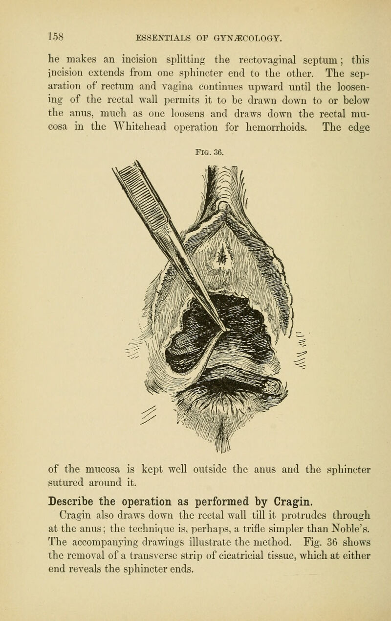 he makes an incision splitting the rectovaginal septum; this incision extends from one sphincter end to the other. The sep- aration of rectum and vagina continues upward until the loosen- ing of the rectal wall permits it to be drawn down to or below the anus, much as one loosens and draws down the rectal mu- cosa in the Whitehead operation for hemorrhoids. The edge Fig. 36. of the mucosa is kept well outside the anus and the sphincter sutured around it. Describe the operation as performed by Cragin. Cragin also draws down the rectal wall till it protrudes through at the anus; the technique is, perhaps, a trifle simpler than Noble's. The accompanying drawings illustrate the method. Fig. 36 shows the removal of a transverse strip of cicatricial tissue, which at either end reveals the sphincter ends.