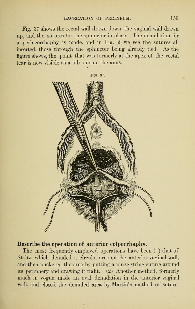 Fig. 37 shows the rectal wall drawn down, the vaginal wall drawn up, and the sutures for the sphincter in place. The denudation for a perineorrhaphy is made, and in Fig. 38 we see the sutures all inserted, those through the sphincter being already tied. As the figure shows, the point that was formerly at the apex of the rectal tear is now visible as a tab outside the anus. Fig. 37. Describe the operation of anterior colporrhaphy. The most frequently employed operations have been (1) that of Stoltz, which denuded a circular area on the anterior vaginal wall, and then puckered the area b}^ putting a purse-string suture around its periphery and drawing it tight. (2) Another method, formerly much in vogue, made an oval denudation in the anterior vaginal wall, and closed the denuded area by Martin's method of suture.